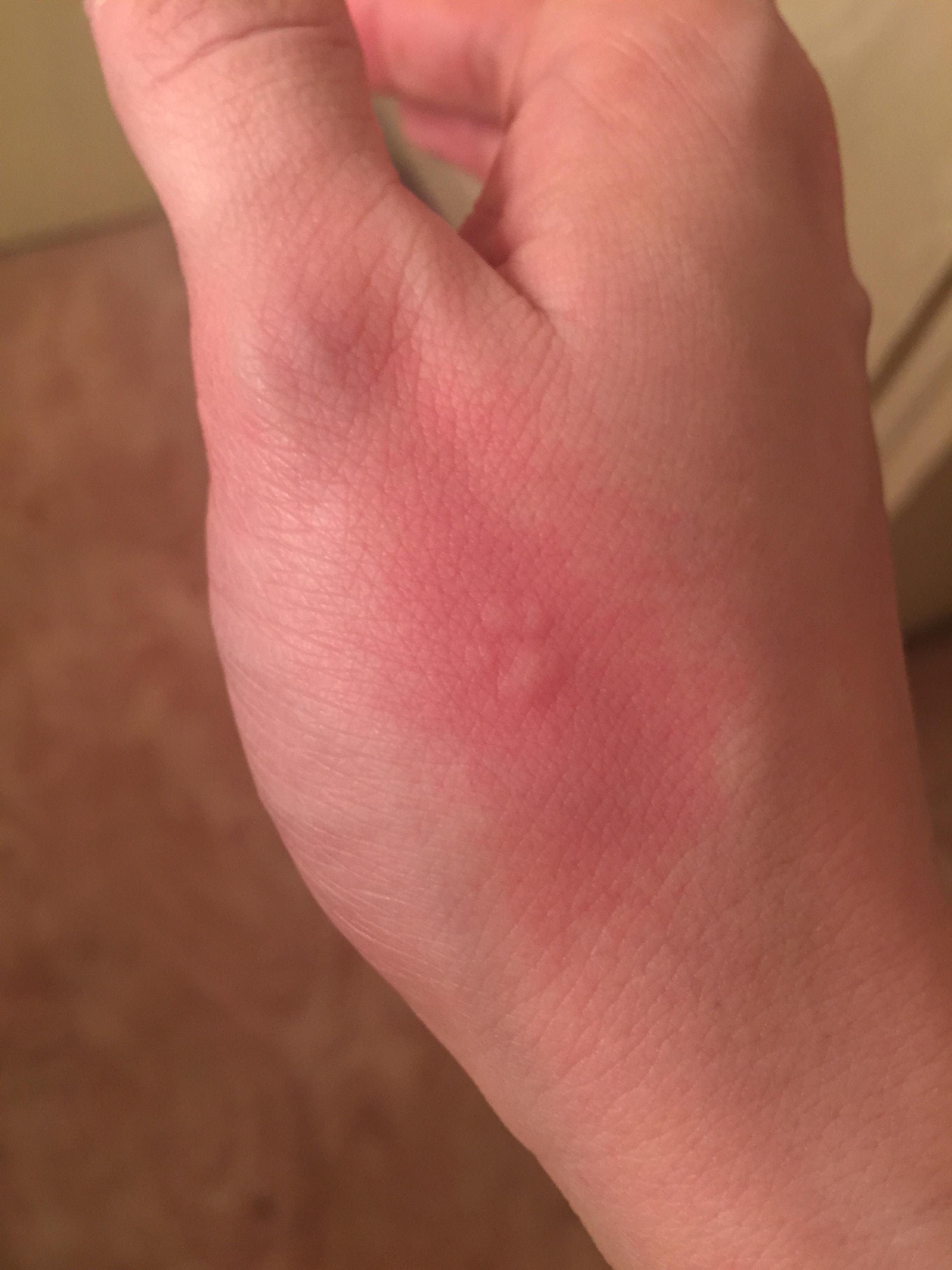 The allergic reaction I'm having to my dog looks like a tiny paw print