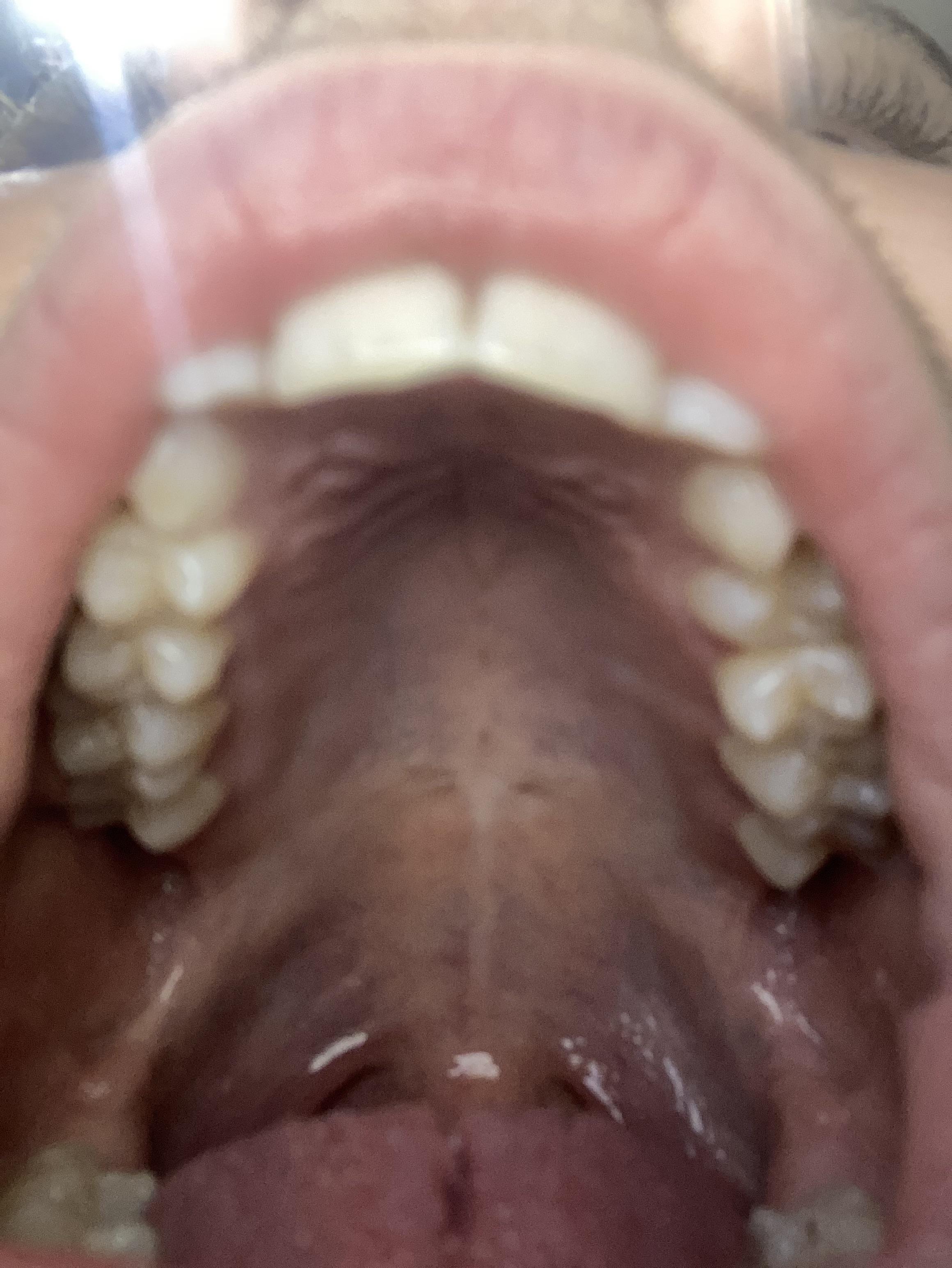 Upper palate r/Mewing