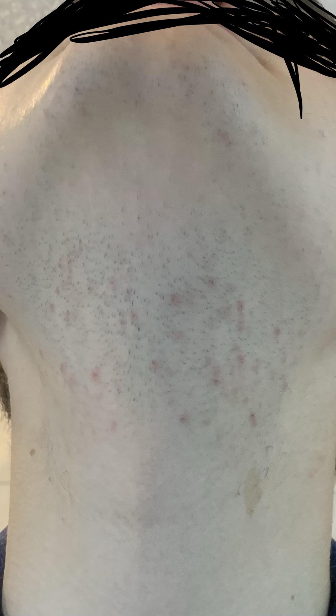 I’ve been getting pimples/red spots on my chin ever since I started shaving with a new