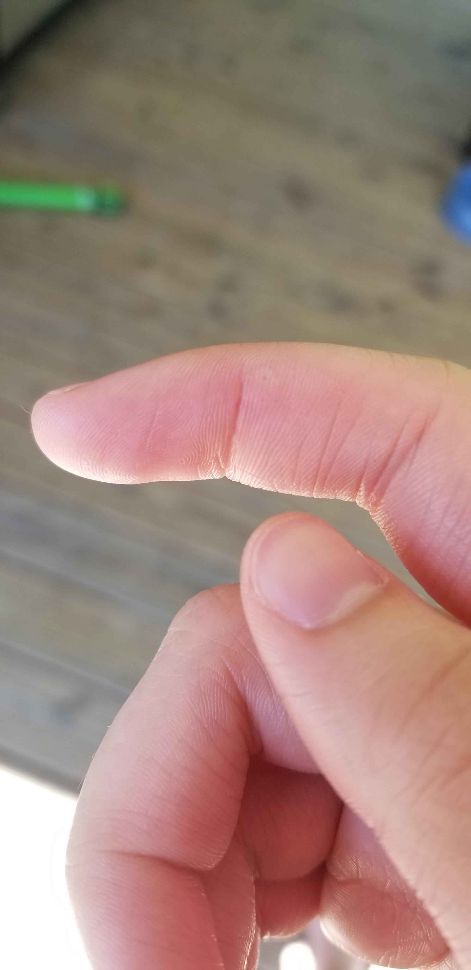 Raised bump on my index finger? r/medical_advice