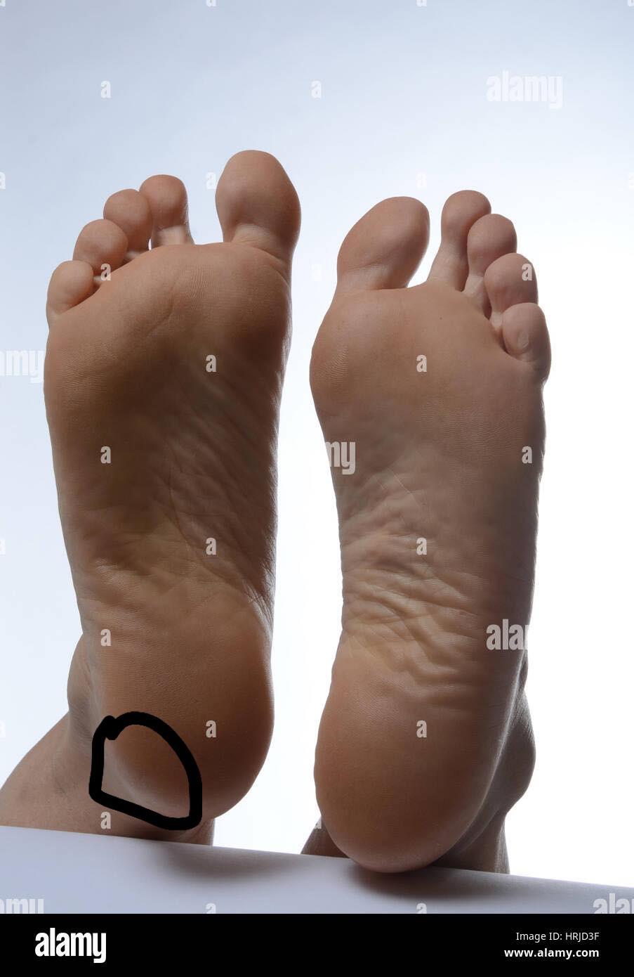 Is this an area of PF , it hurts when I walk on it for a bit , is this