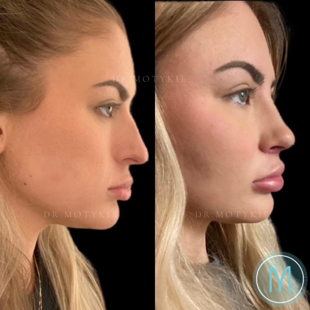 One month postop Rhinoplasty + Lip Lift + Facial Fat Grafting r/cosmeticsurgery