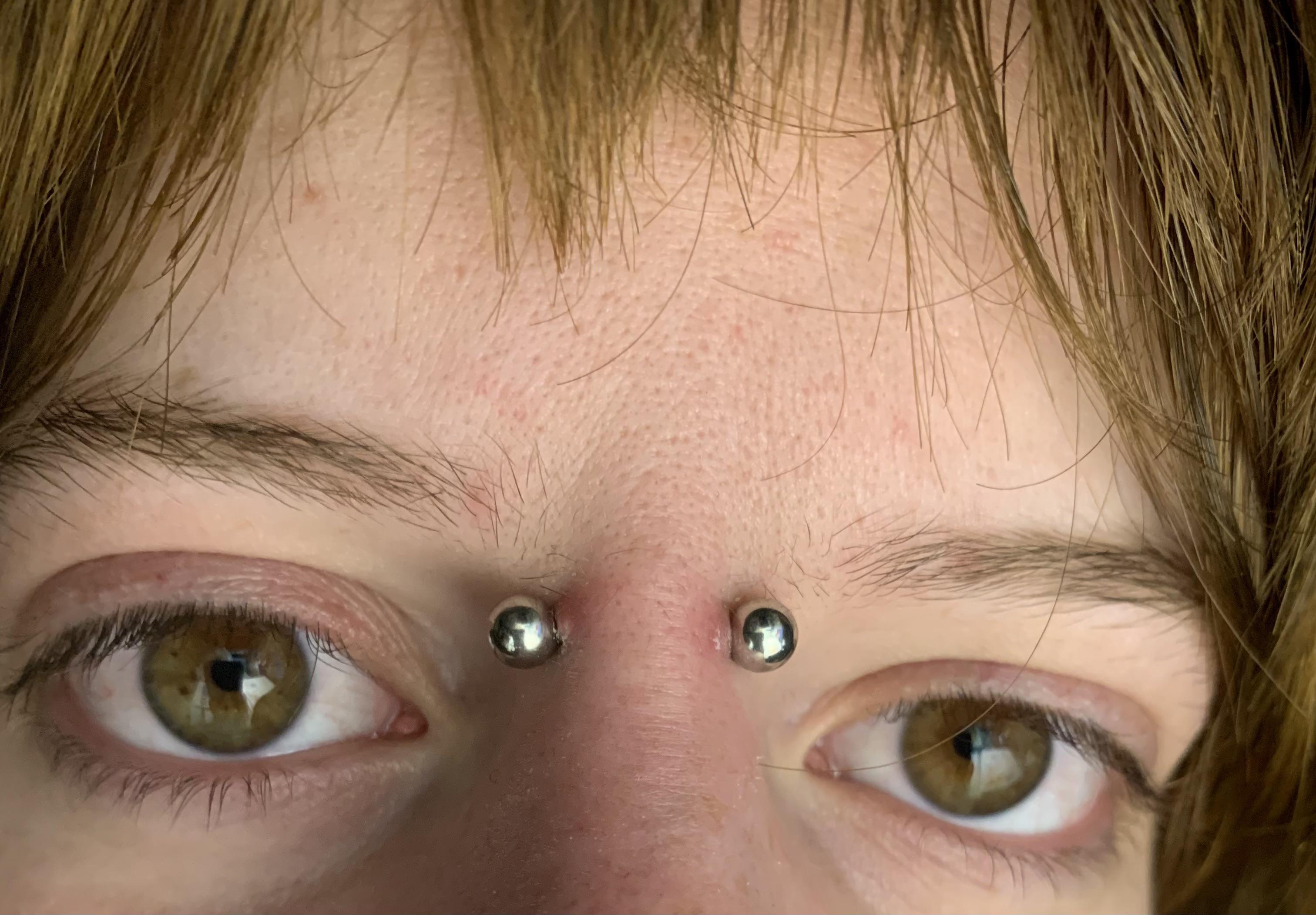 Bridge Piercing Infection