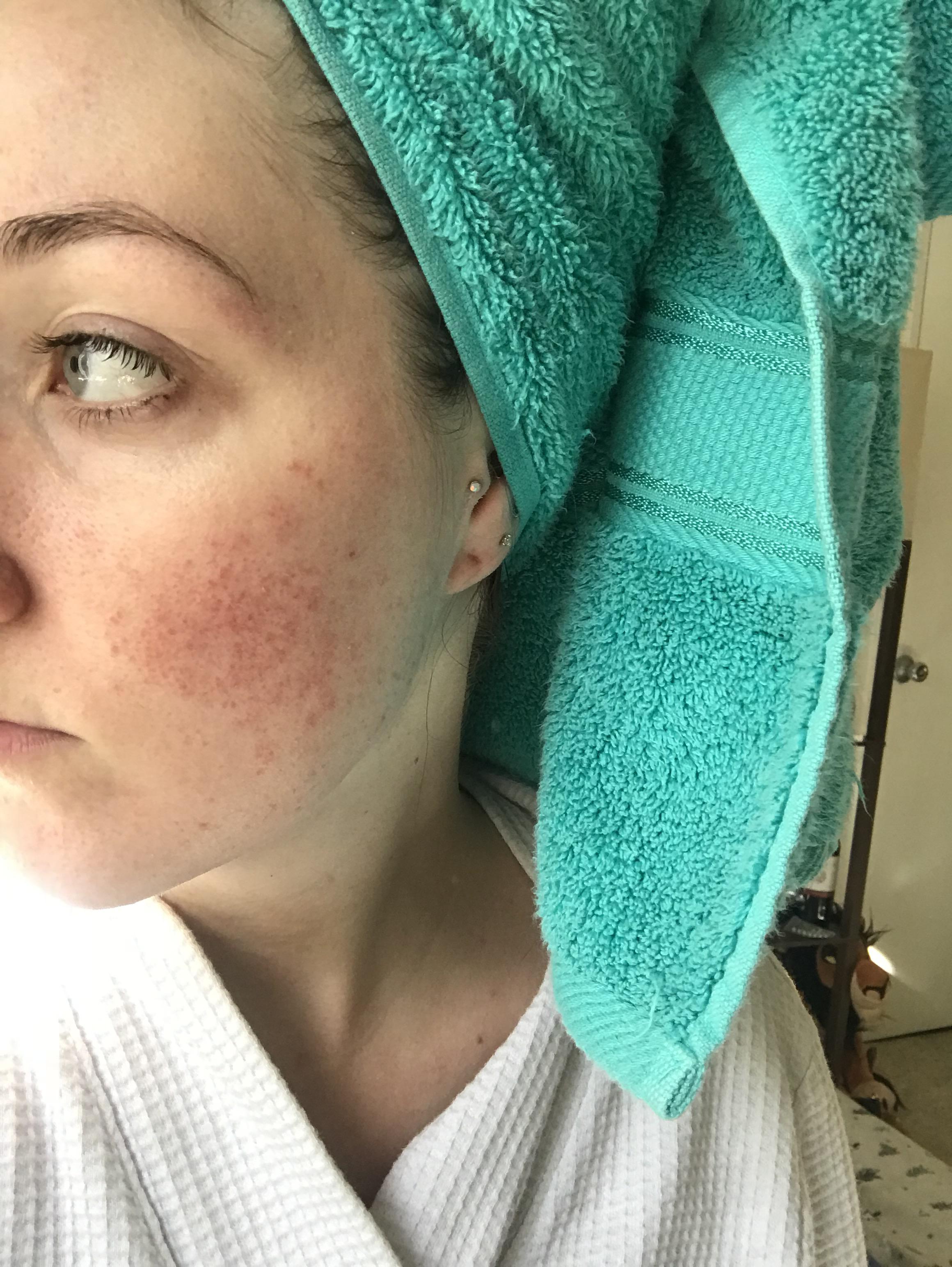 Red dots on face, appeared about 3 years ago and gradually got worse