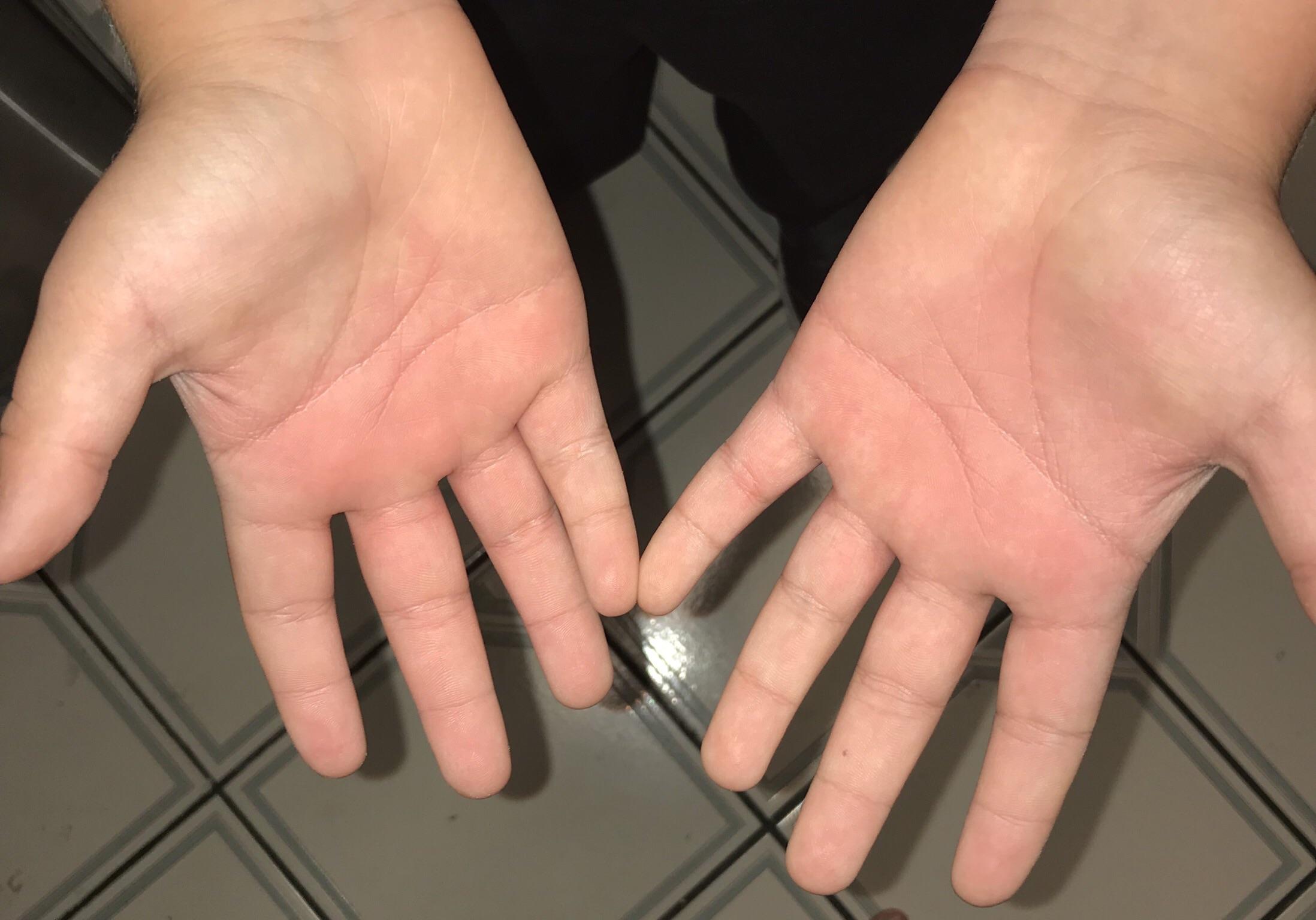 Help Doctors of reddit! For the last week my son has been waking up with his palms burning and