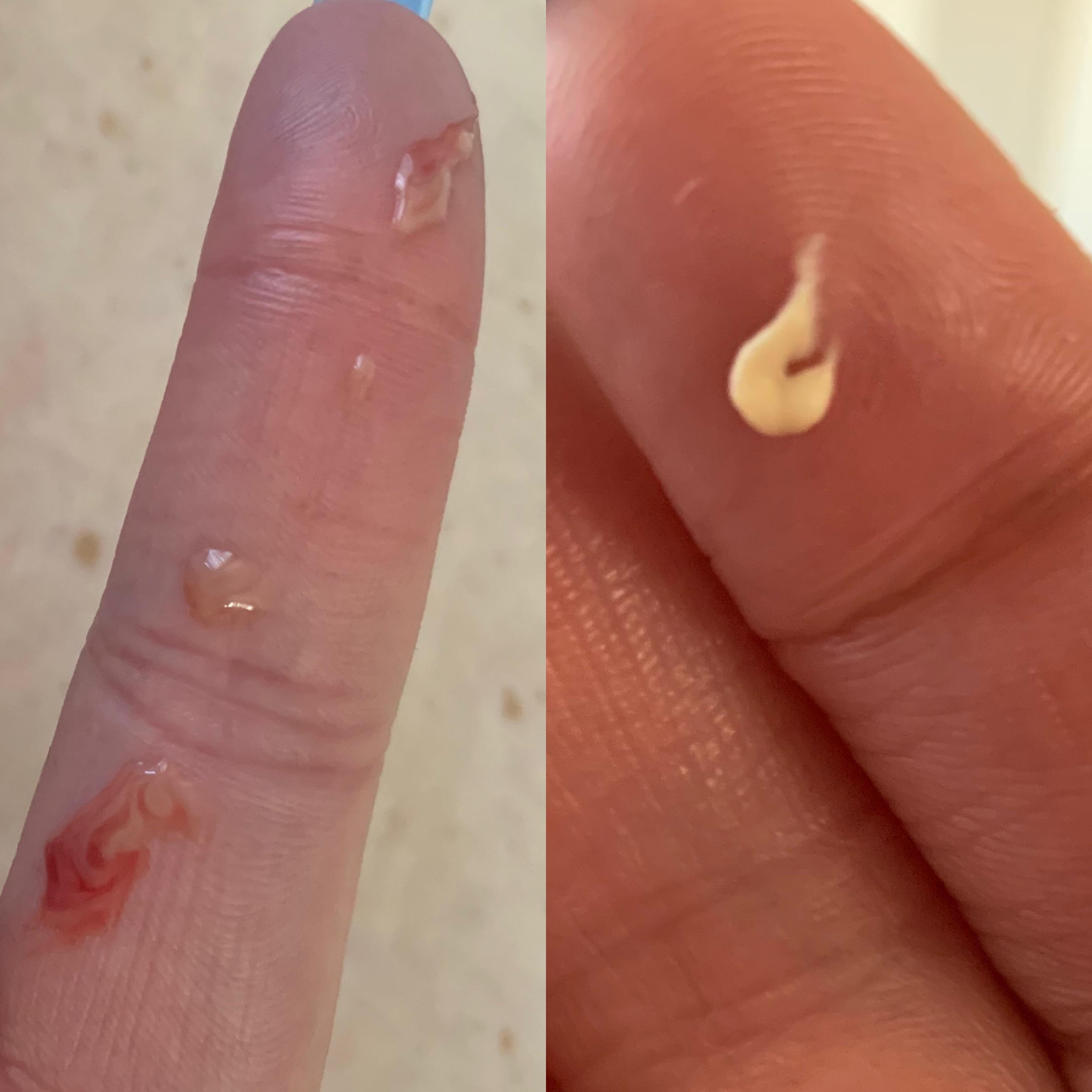 Buried boil on inner thigh — the juicy spray happened and then the this