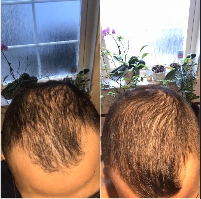 Dermaroller (1mm) progress after almost 2 months, used nothing else