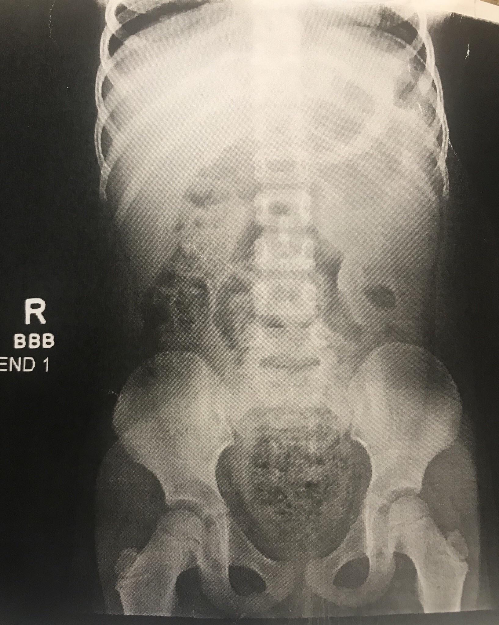 4 Year old Cystic Fibrosis Patient. History meconium ileus corrected
