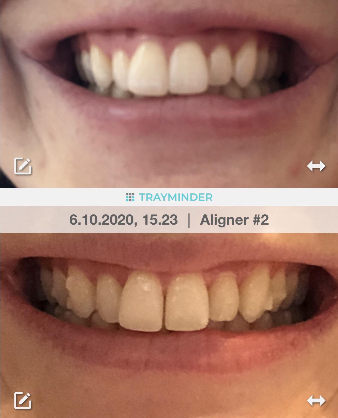 Only on tray 2/9 and seeing a huge improvement already! Invisalign