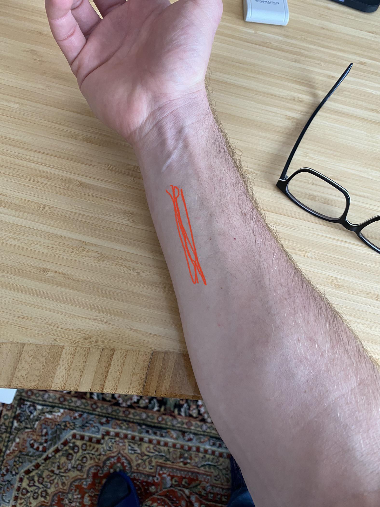 Pain in forearm. What is it? r/piano