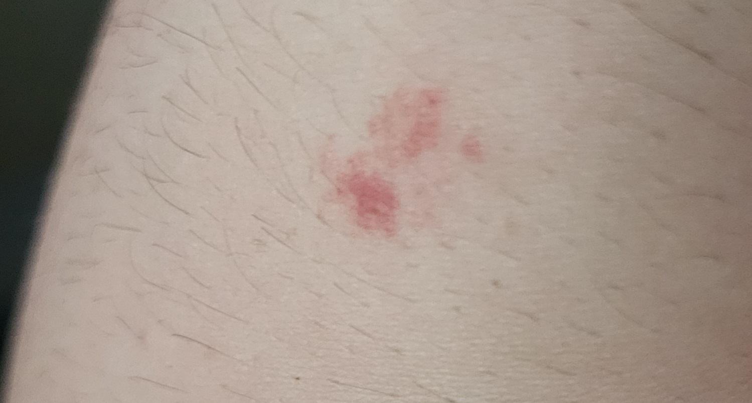 getting red splotches like this on my arm and leg. some bigger than