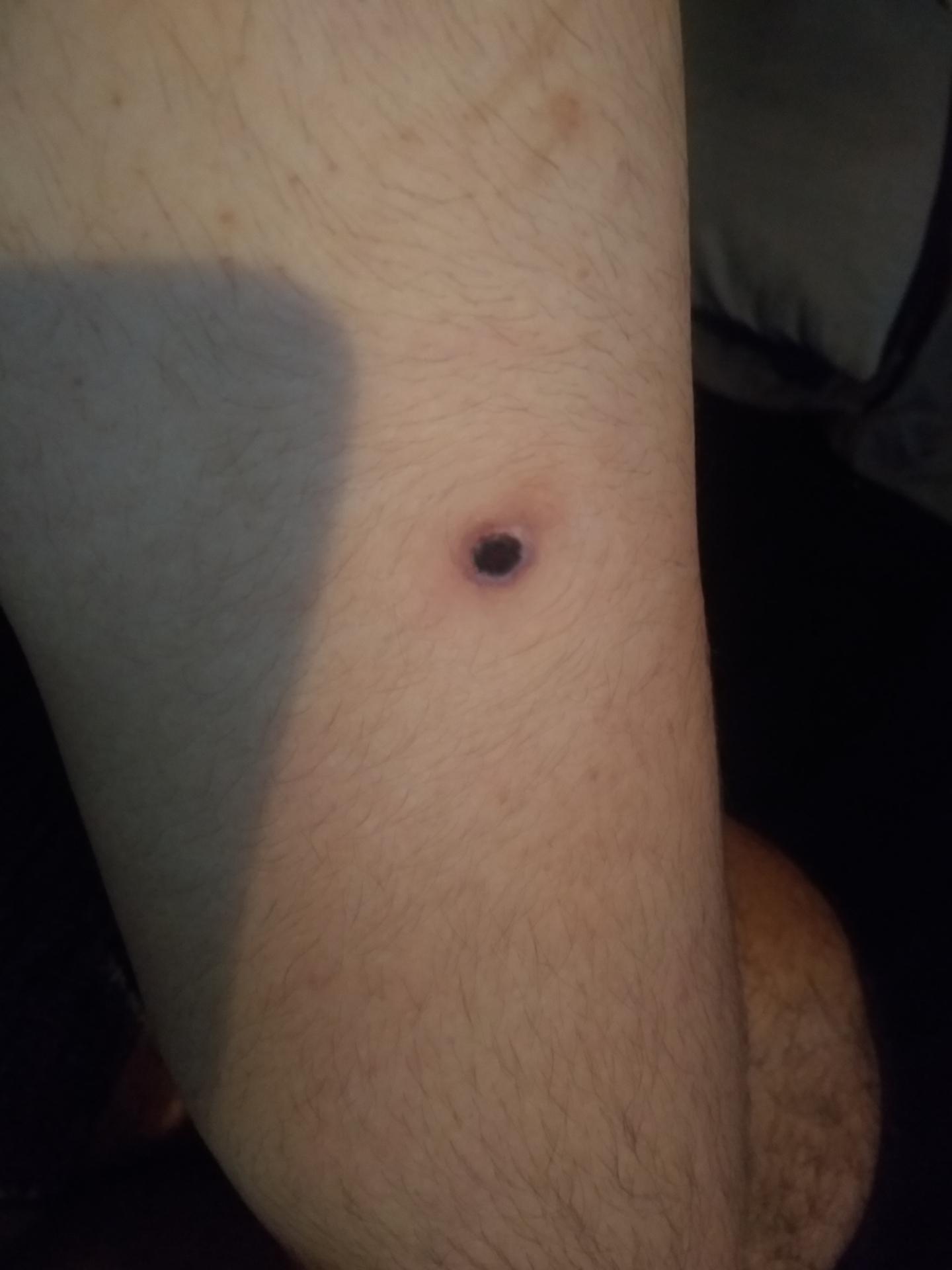 Giant Black Head that's been growing on my arm... Honestly been excited