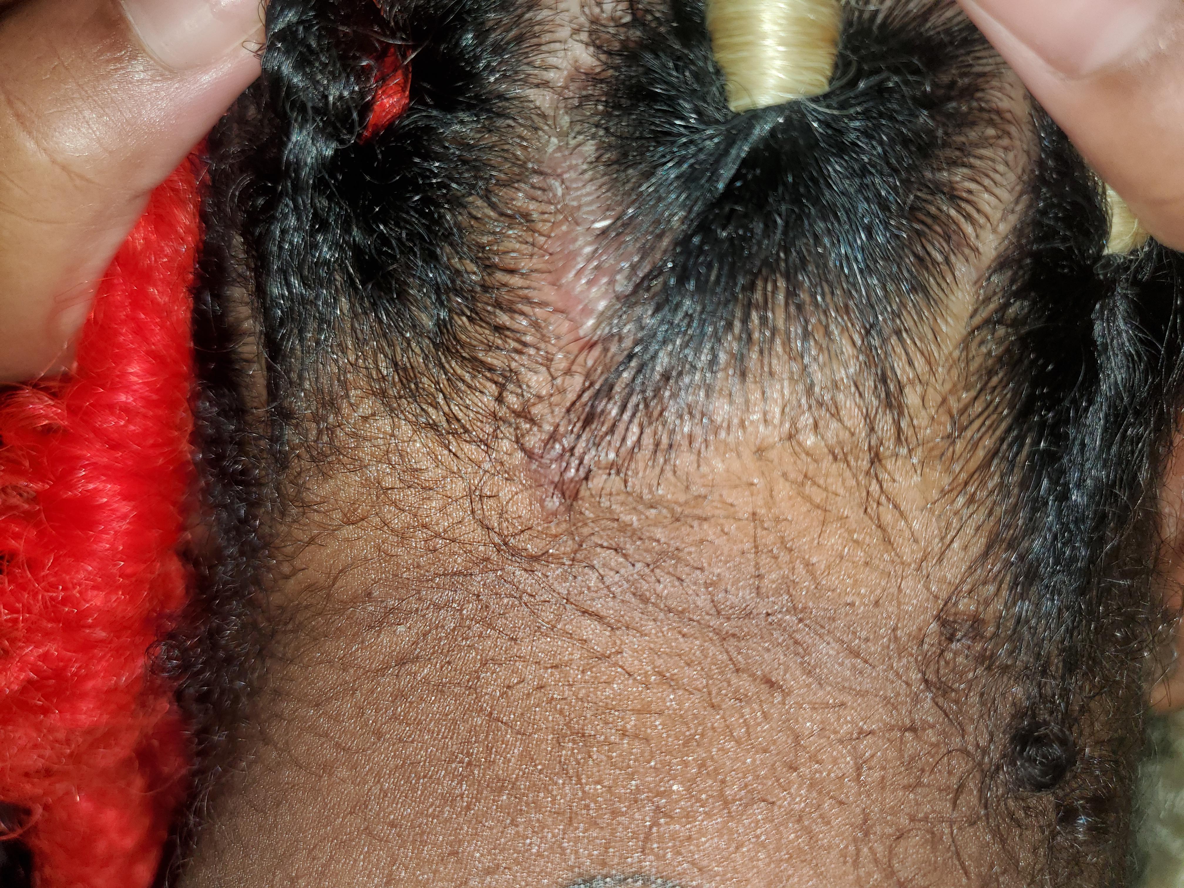 hair bump/ traction alopecia Naturalhair