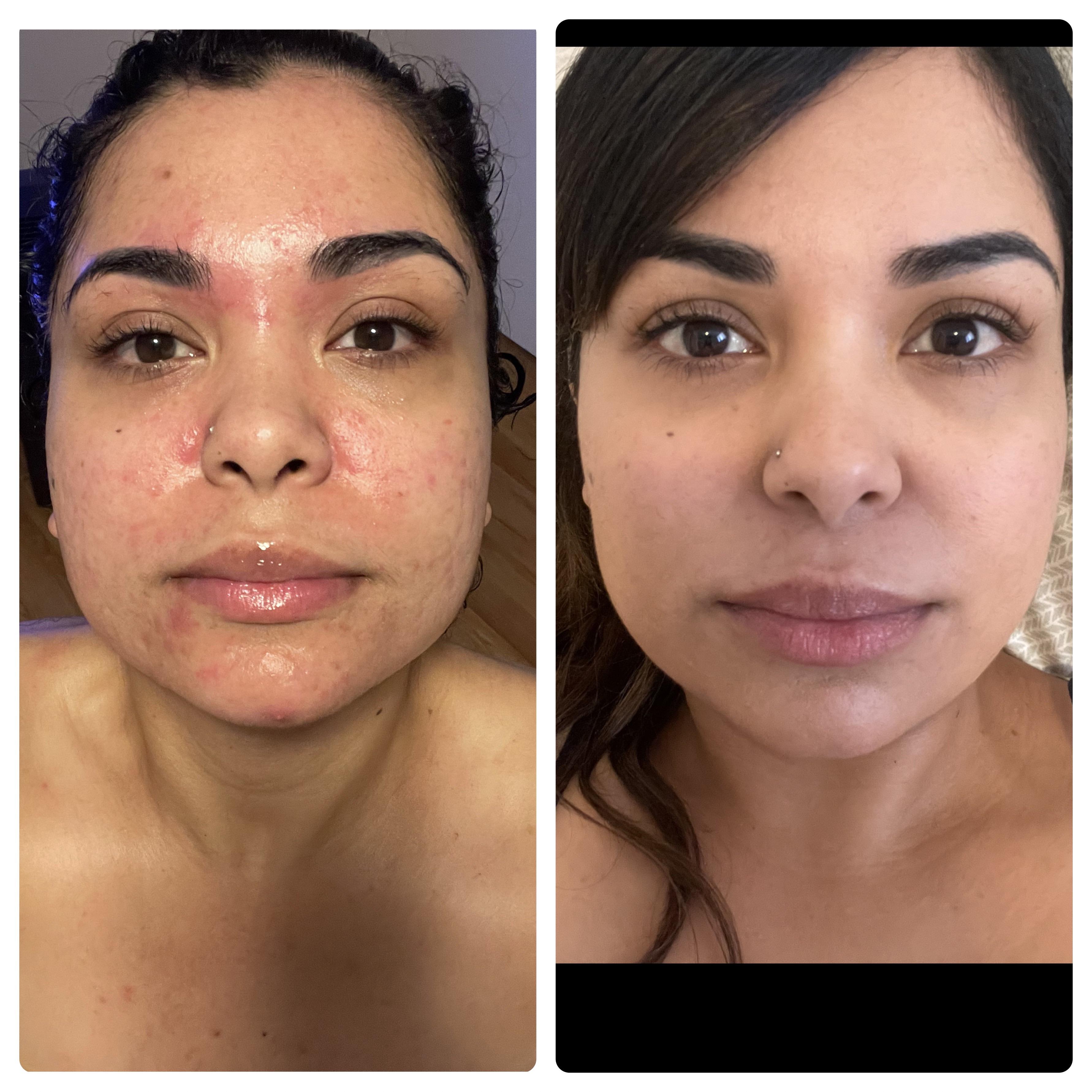 4 months on Accutane r/Accutane