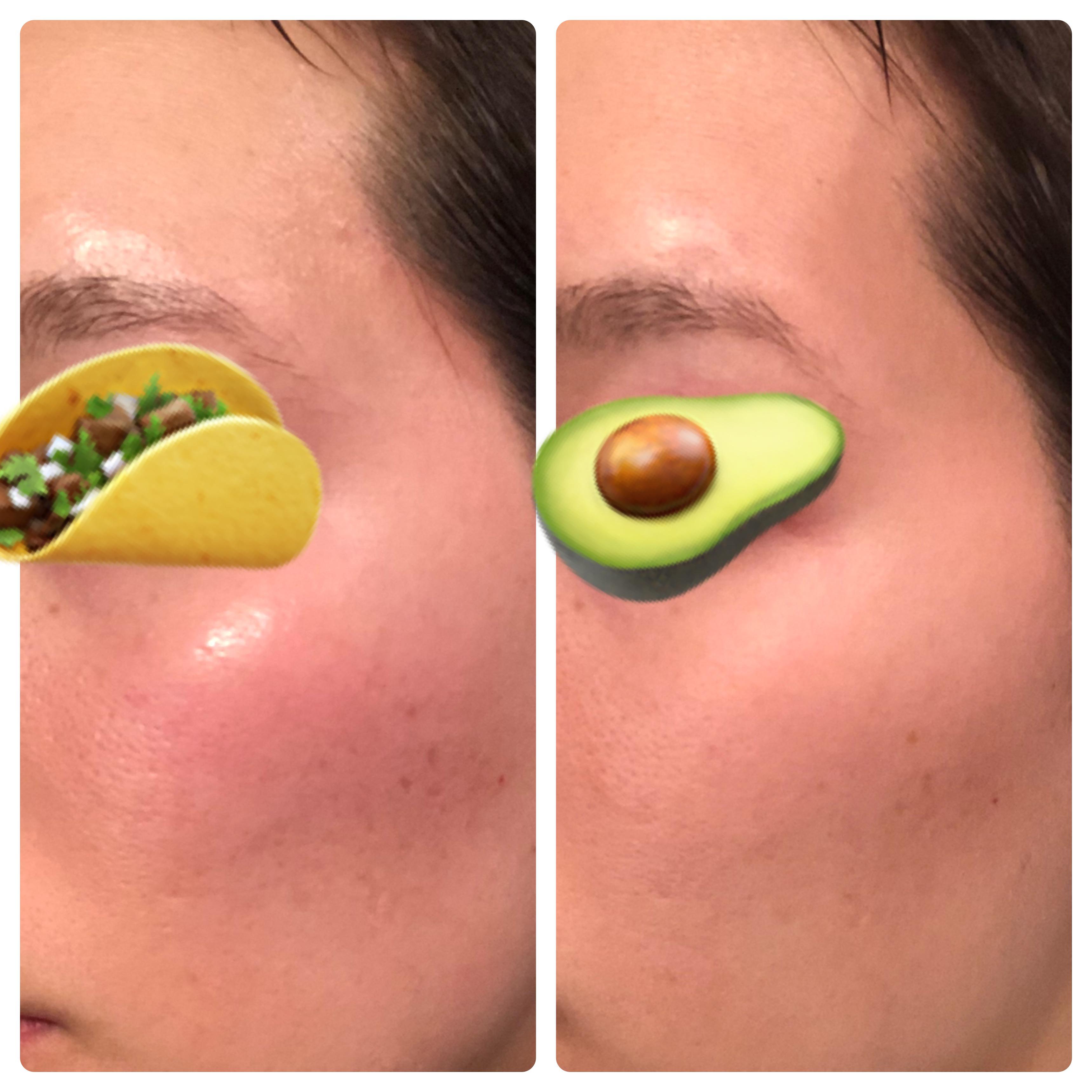 Slurp Niacid results May 13June 1 r/SkincareAddicts