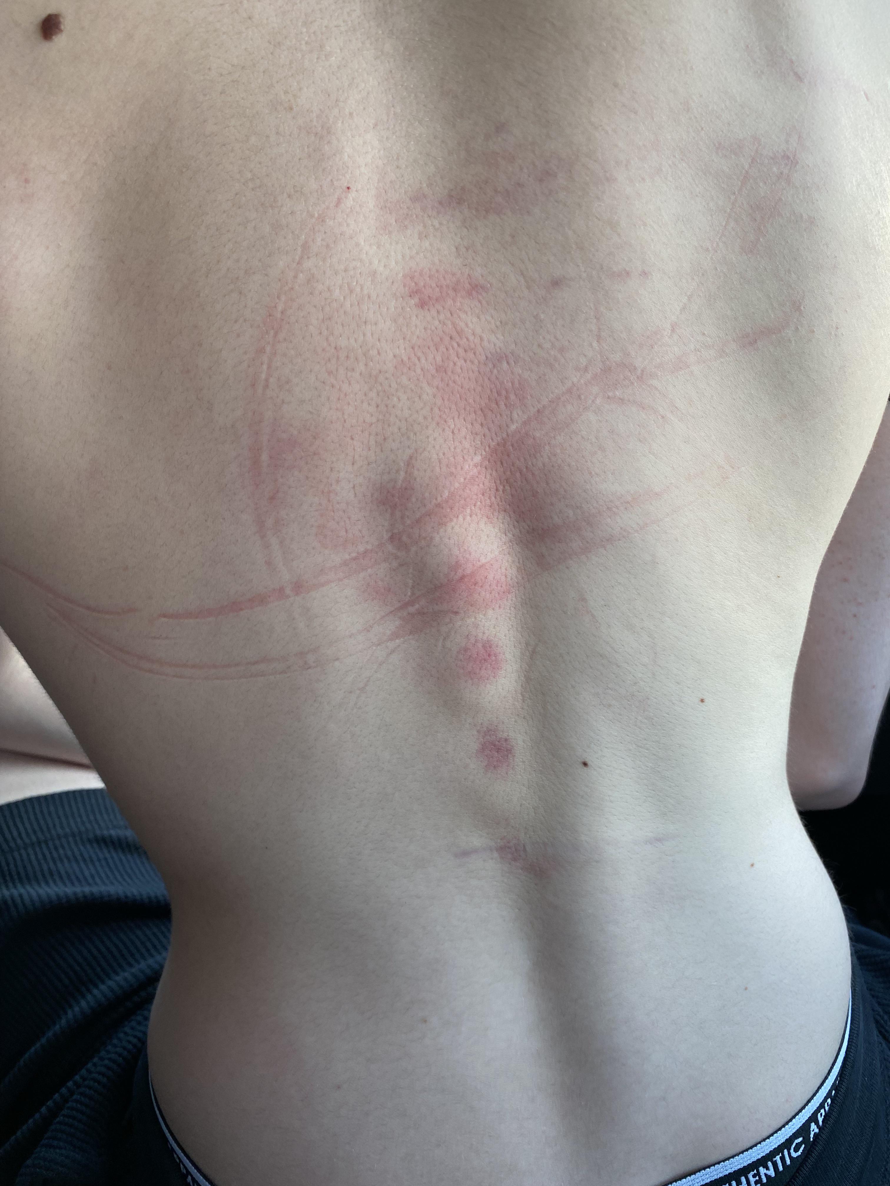 I call them my battle scars r/WredditSchool