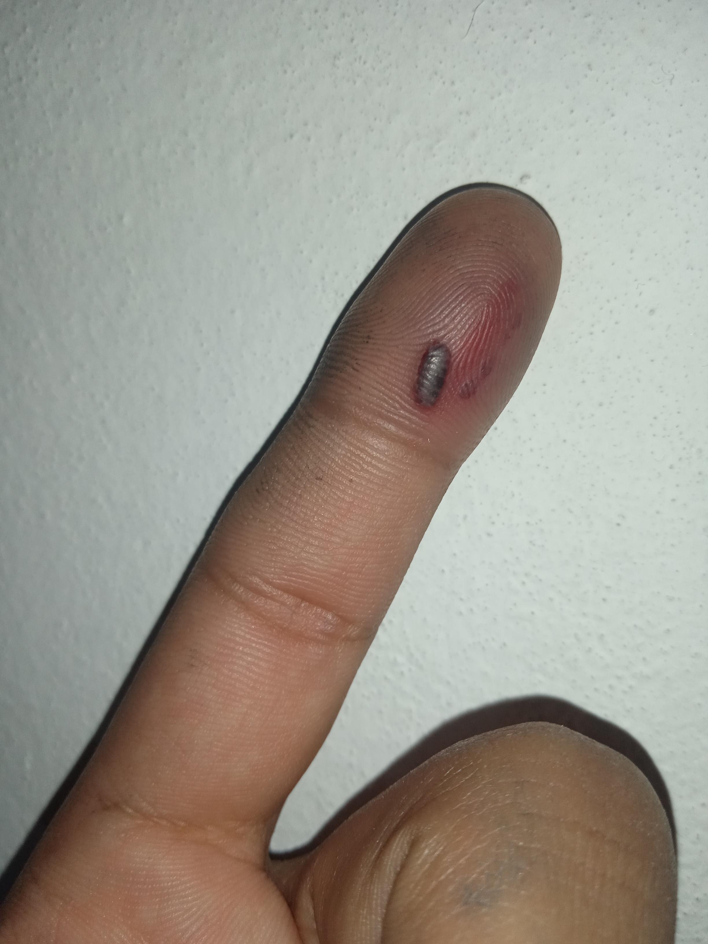 This is how my finger looks like after I pinched it with a pliers. r