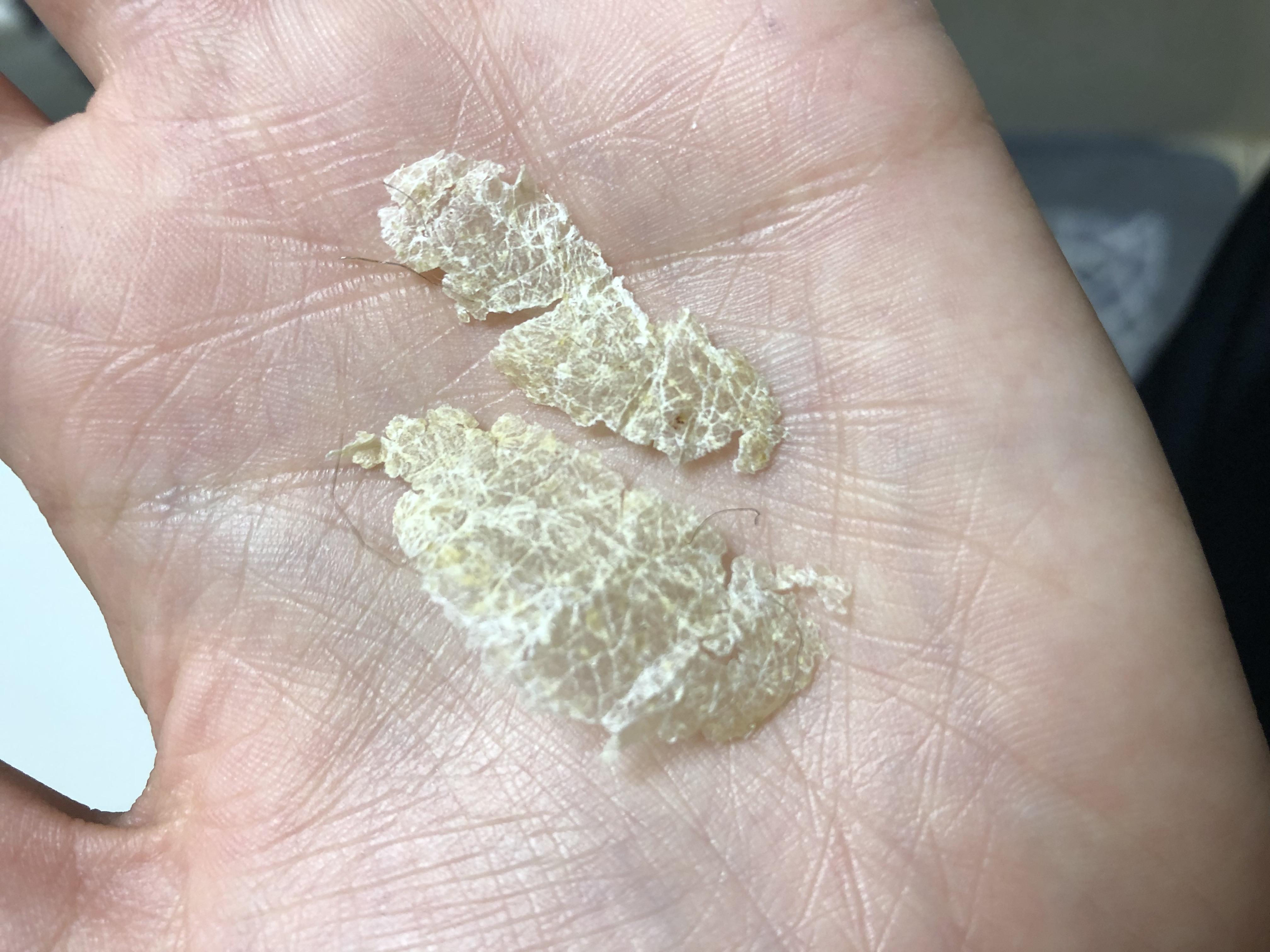 My psoriasis scales came off in the best way possible nearly all at