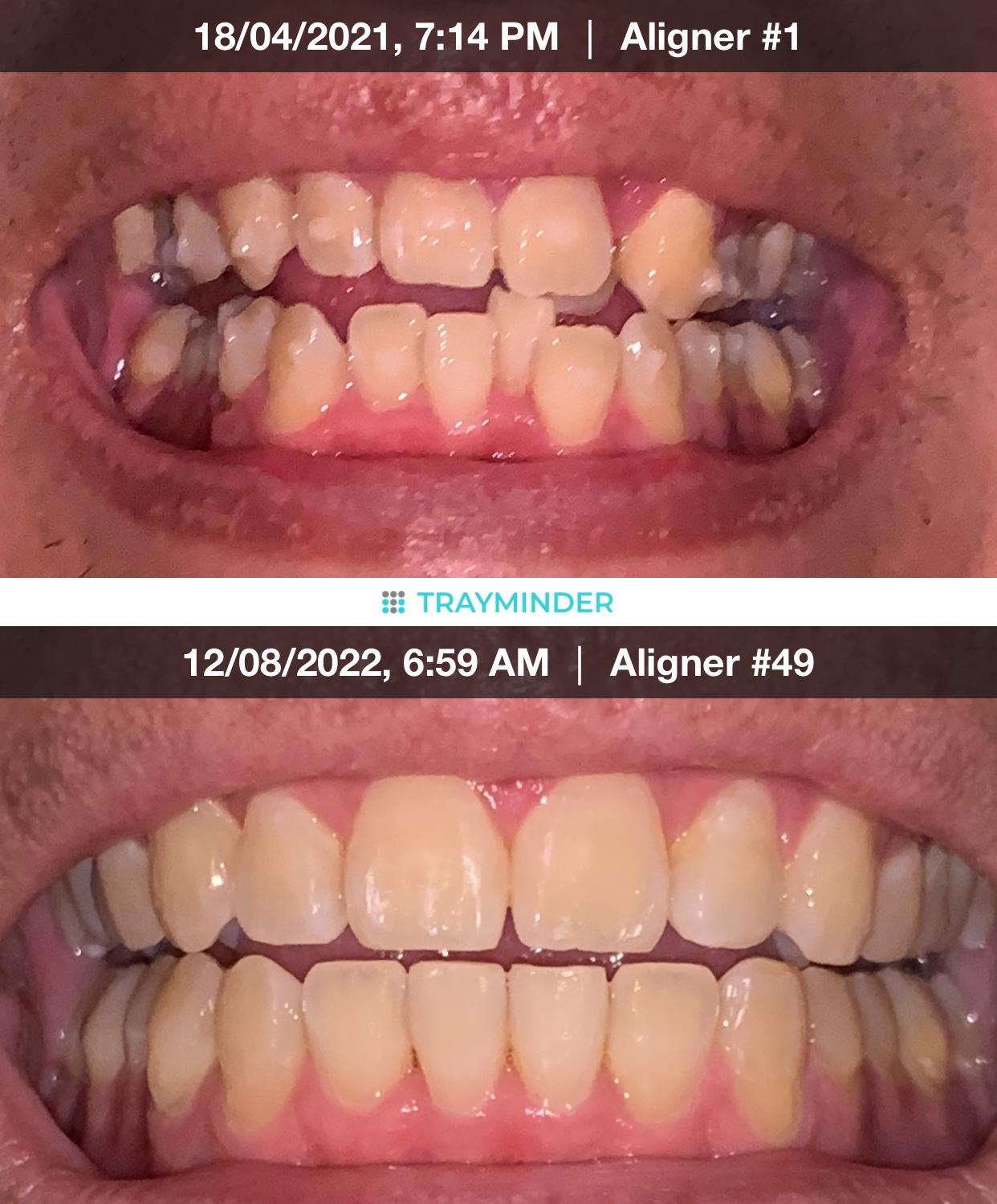 To those with regrets getting Invisalign, pains and aches, etc. r