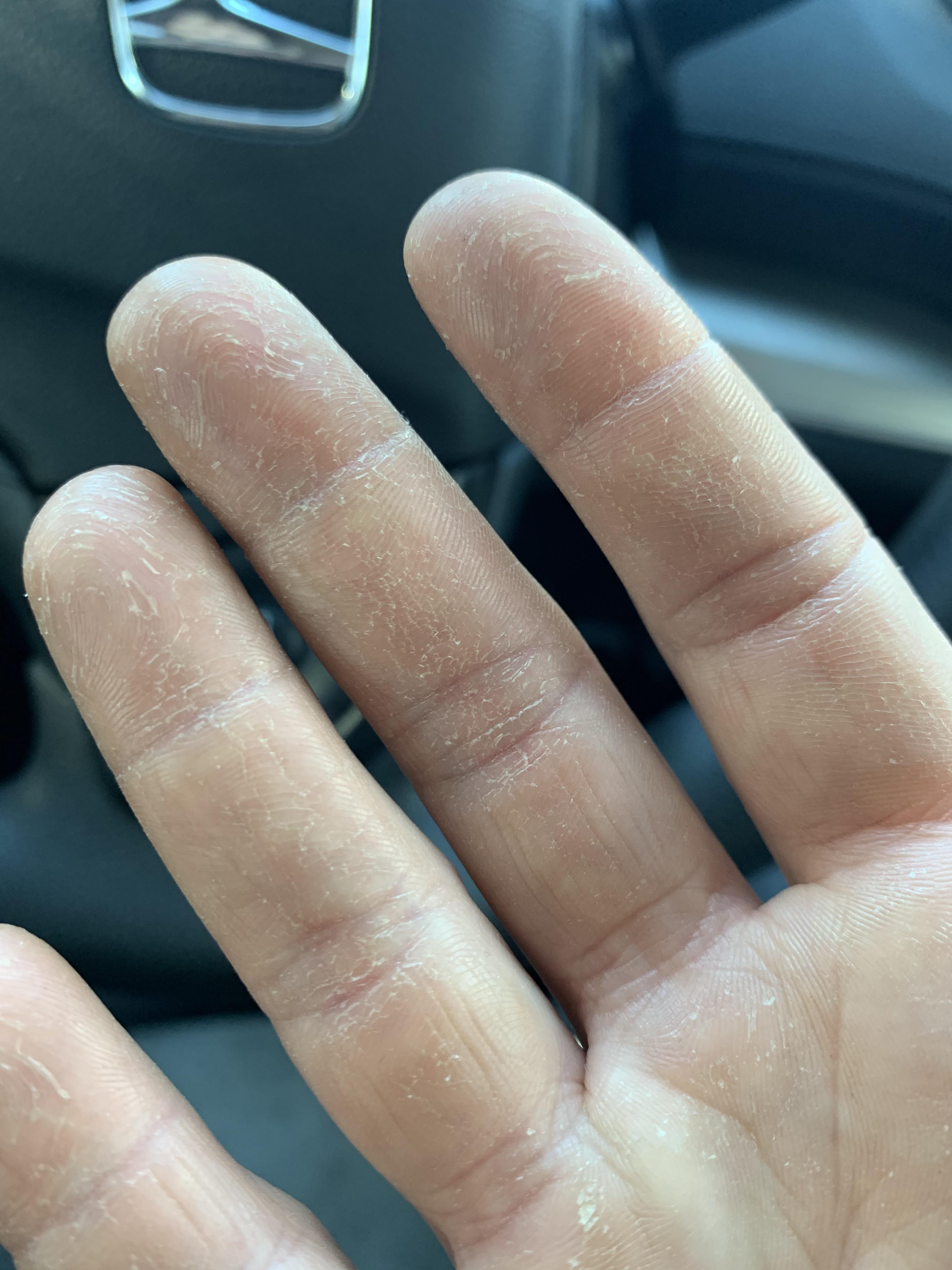 Hands had prolonged exposure (15 mins) to chemicals at work, no warning