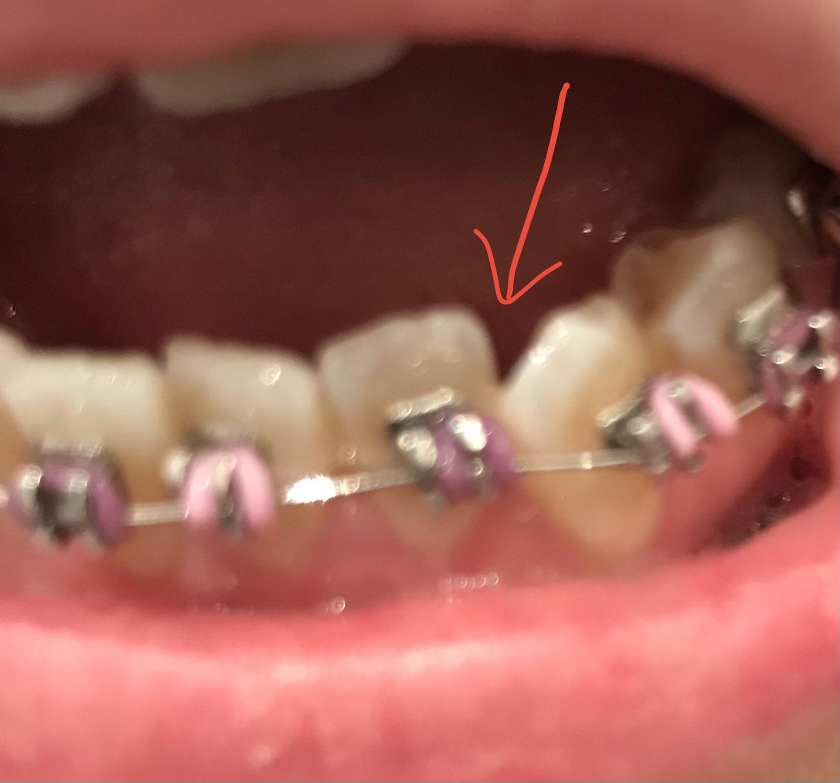Brace newbie. Cement between these teeth so can’t floss. Should I worry