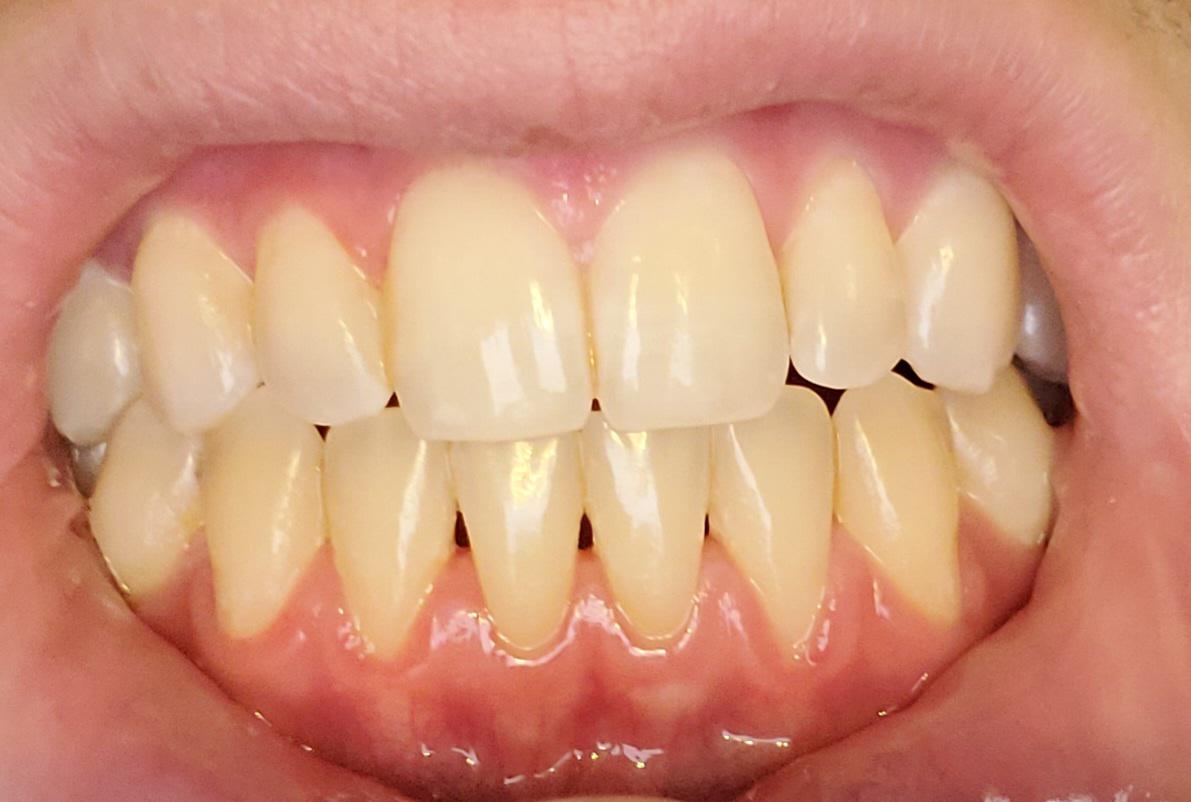 Receding Gums Along With Holes In Between My Teeth. 21 Year Old Male