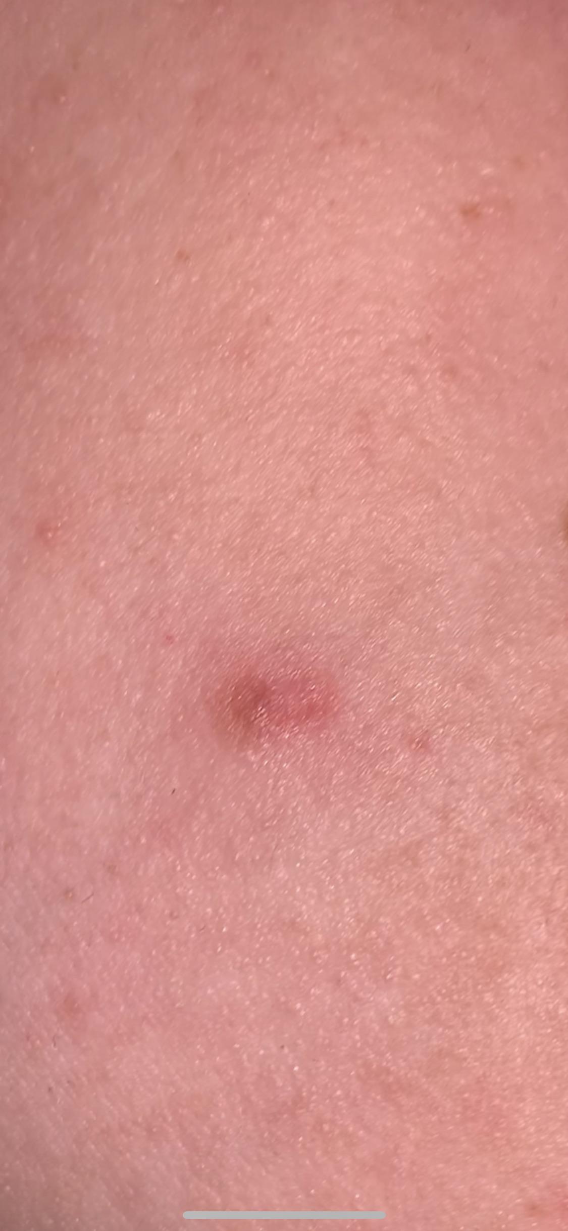 Something I should get checked out? Raised bump on side of cheek which