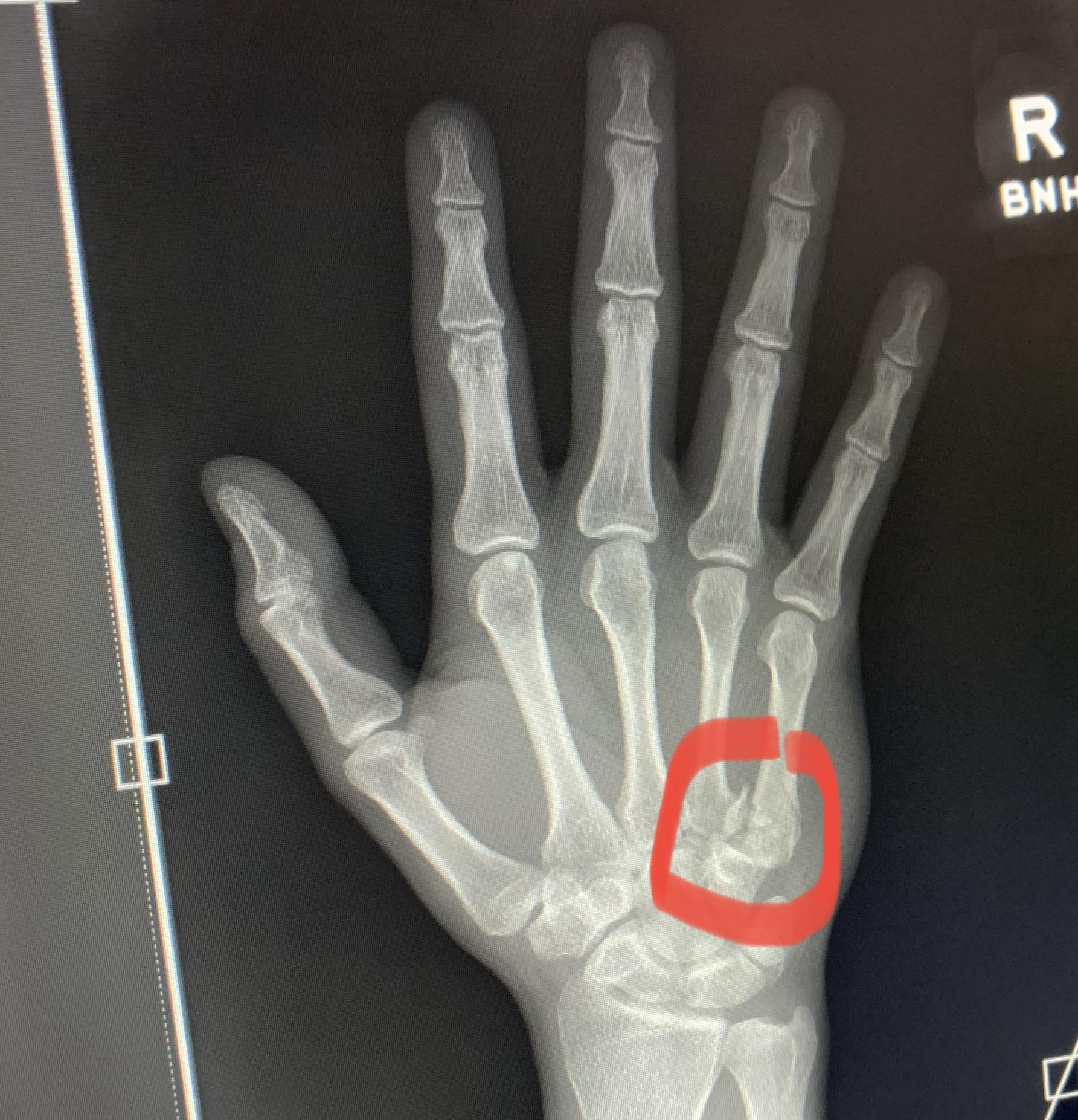 I have a boxer’s fracture in my right hand and I’m really worried about