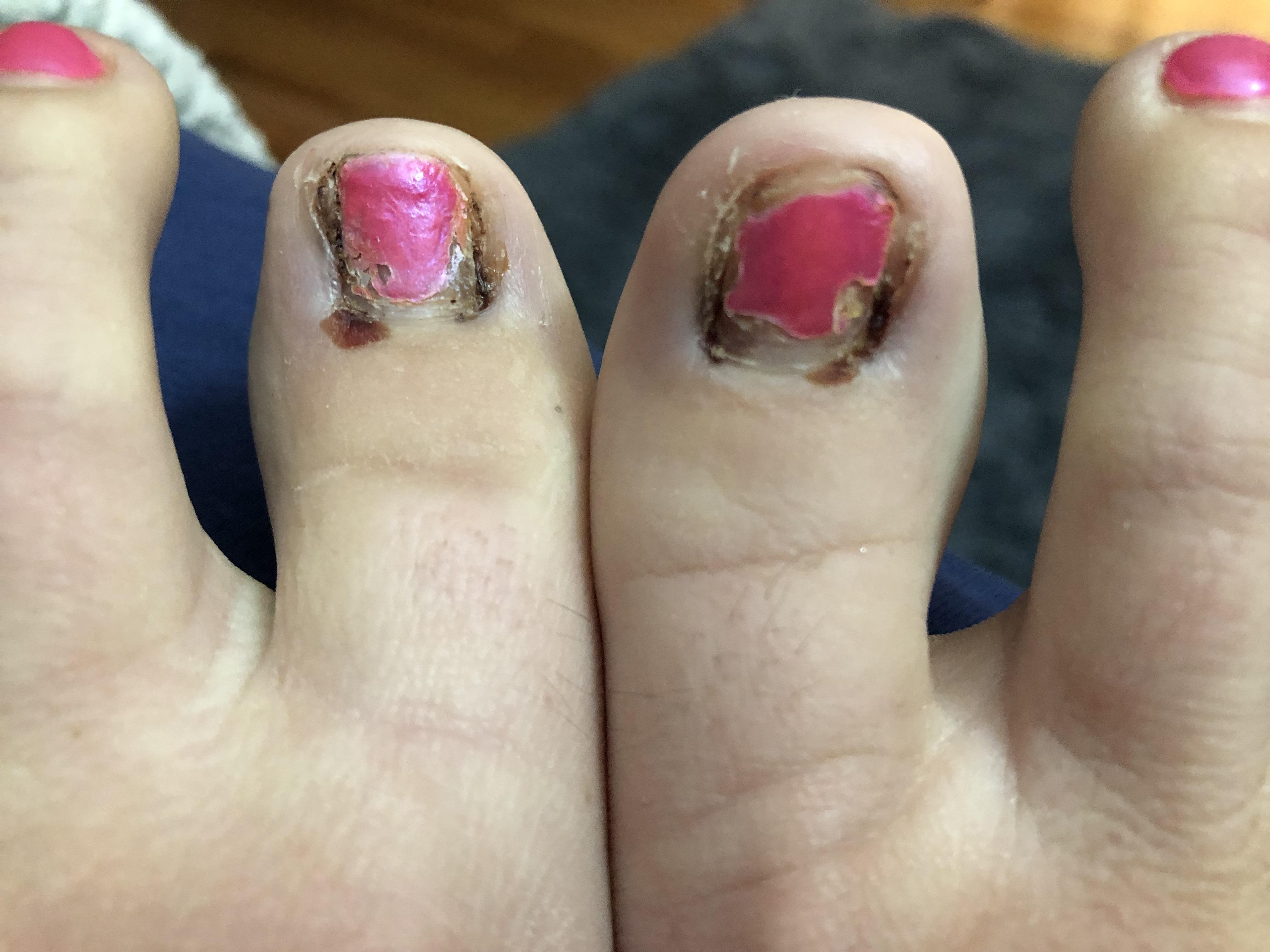 Blood blisters 3 weeks after my ingrown toenail removal. Does this look