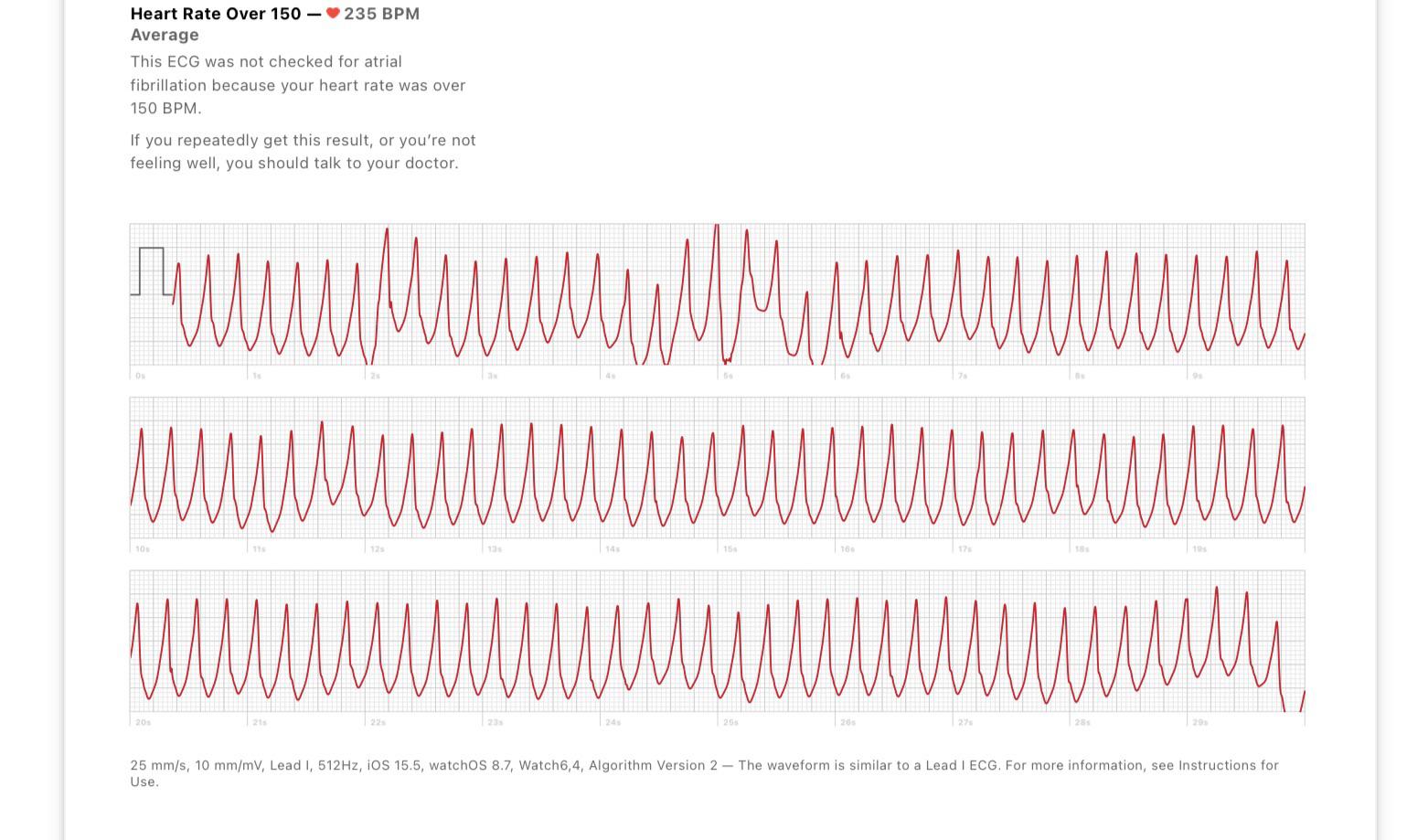 PVC on Kardia reading? r/PVCs