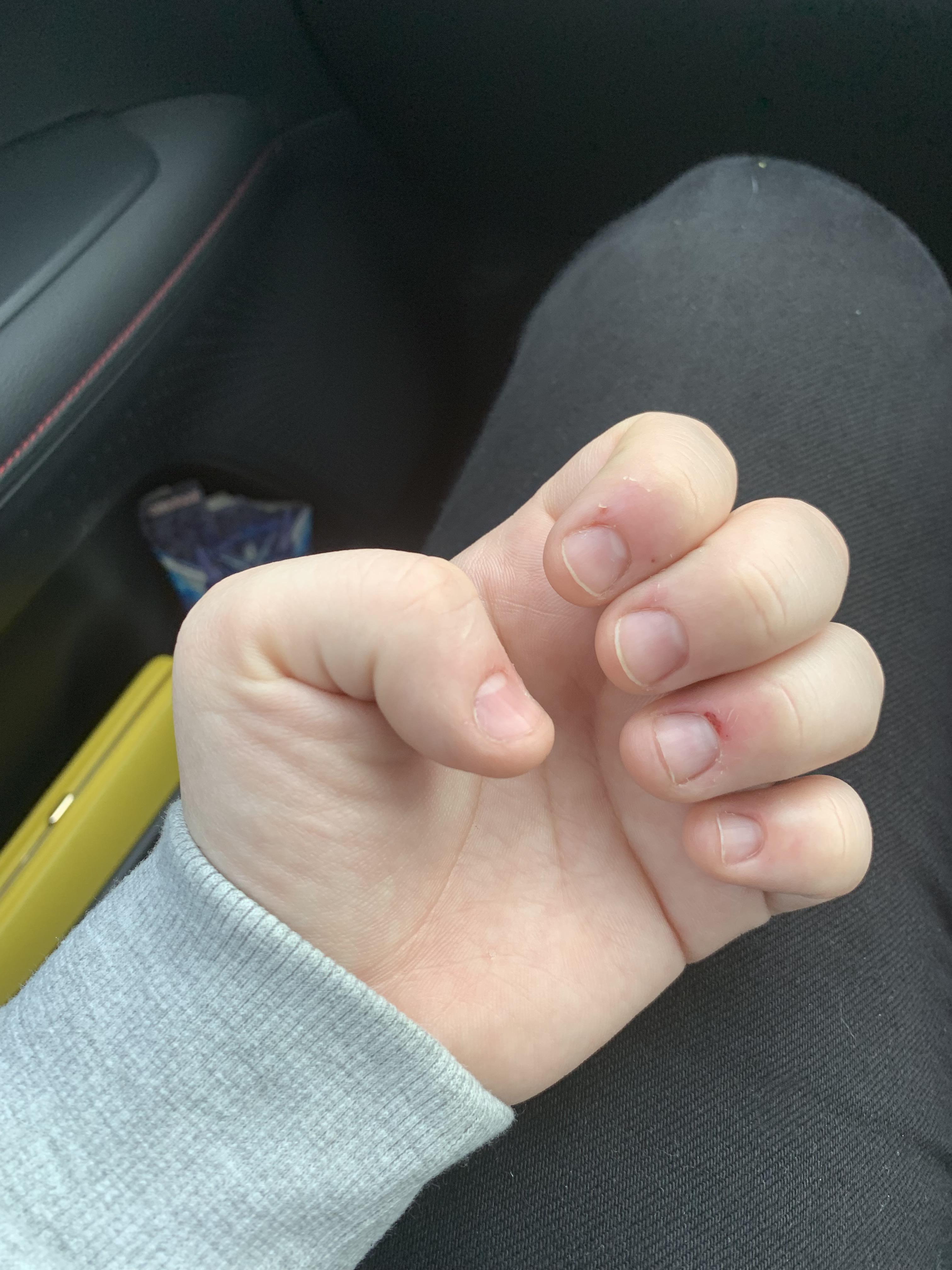 So I rip into my cuticles and bite my nails until it hurts. I spent all