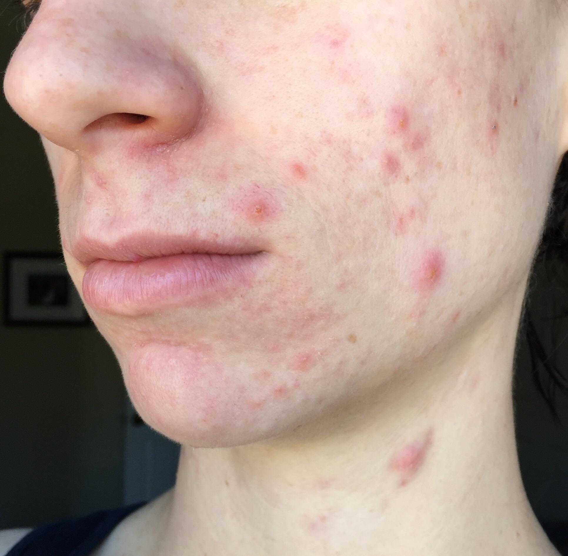 [Routine help] acne, redness, breastfeeding limits products r