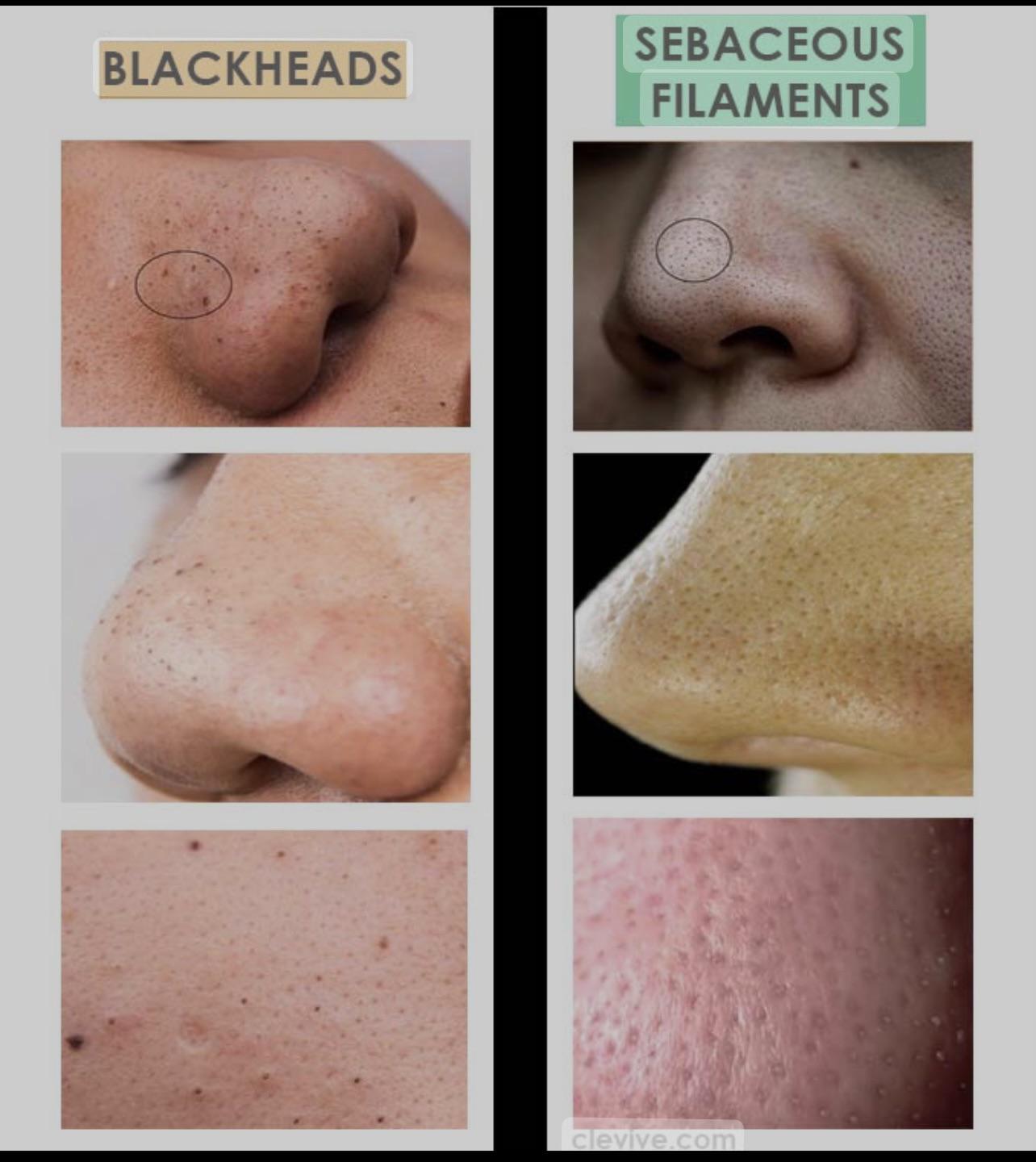 Sebaceous Filaments who has them and what has been good to treat them