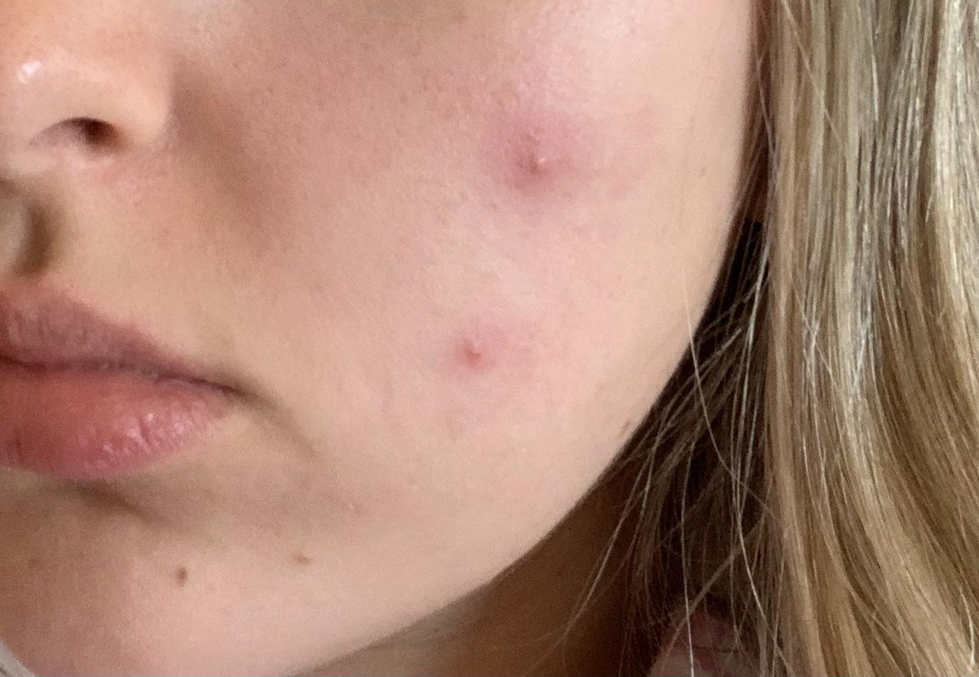 [acne] I had cystic acne appear overnight. Any advice on how to clear