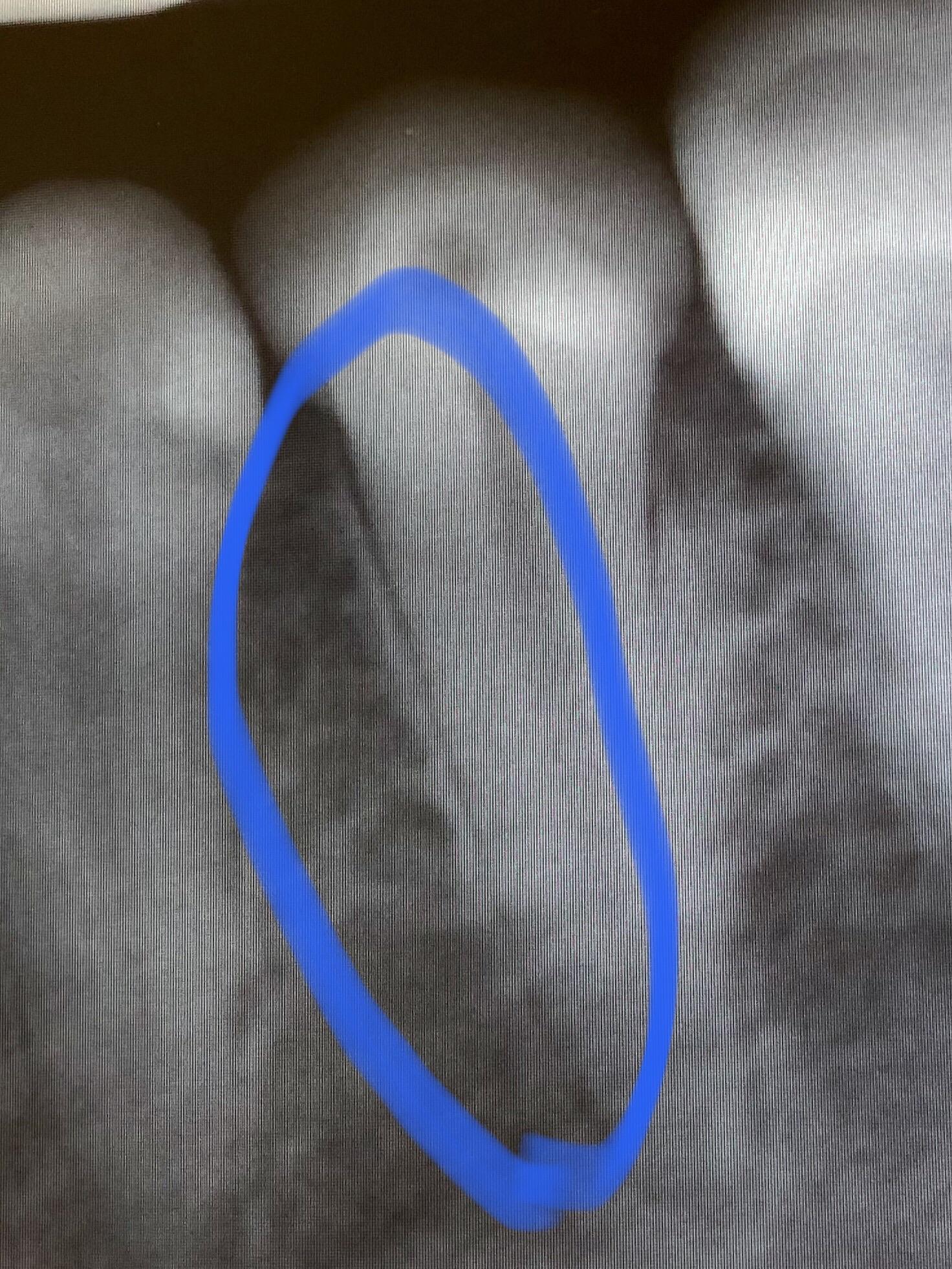 Proud of me? My teeth/jaw were so strong I sprained my tooth ligament