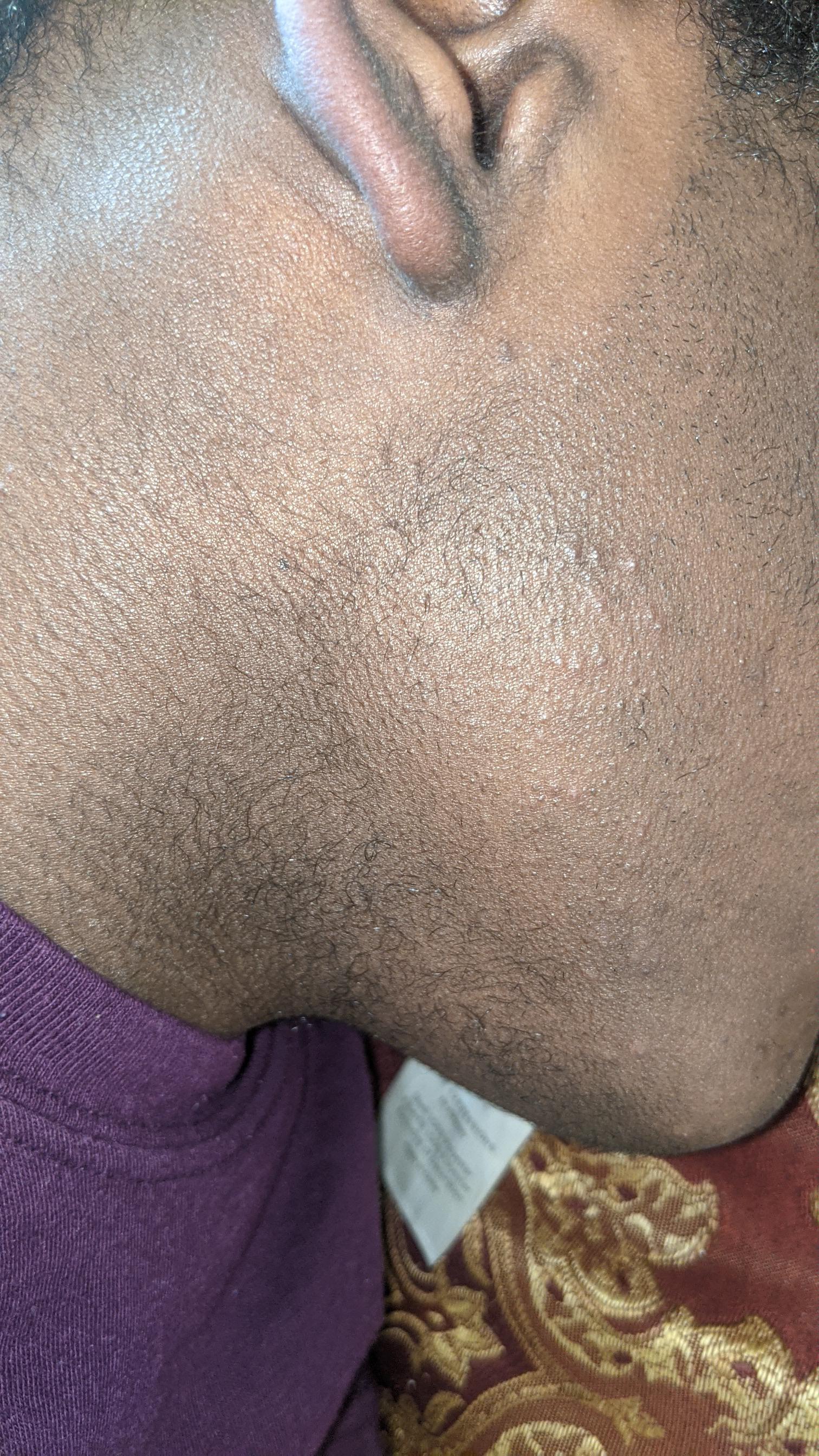 Need some help with these razor bumps. Also deciding to switch from