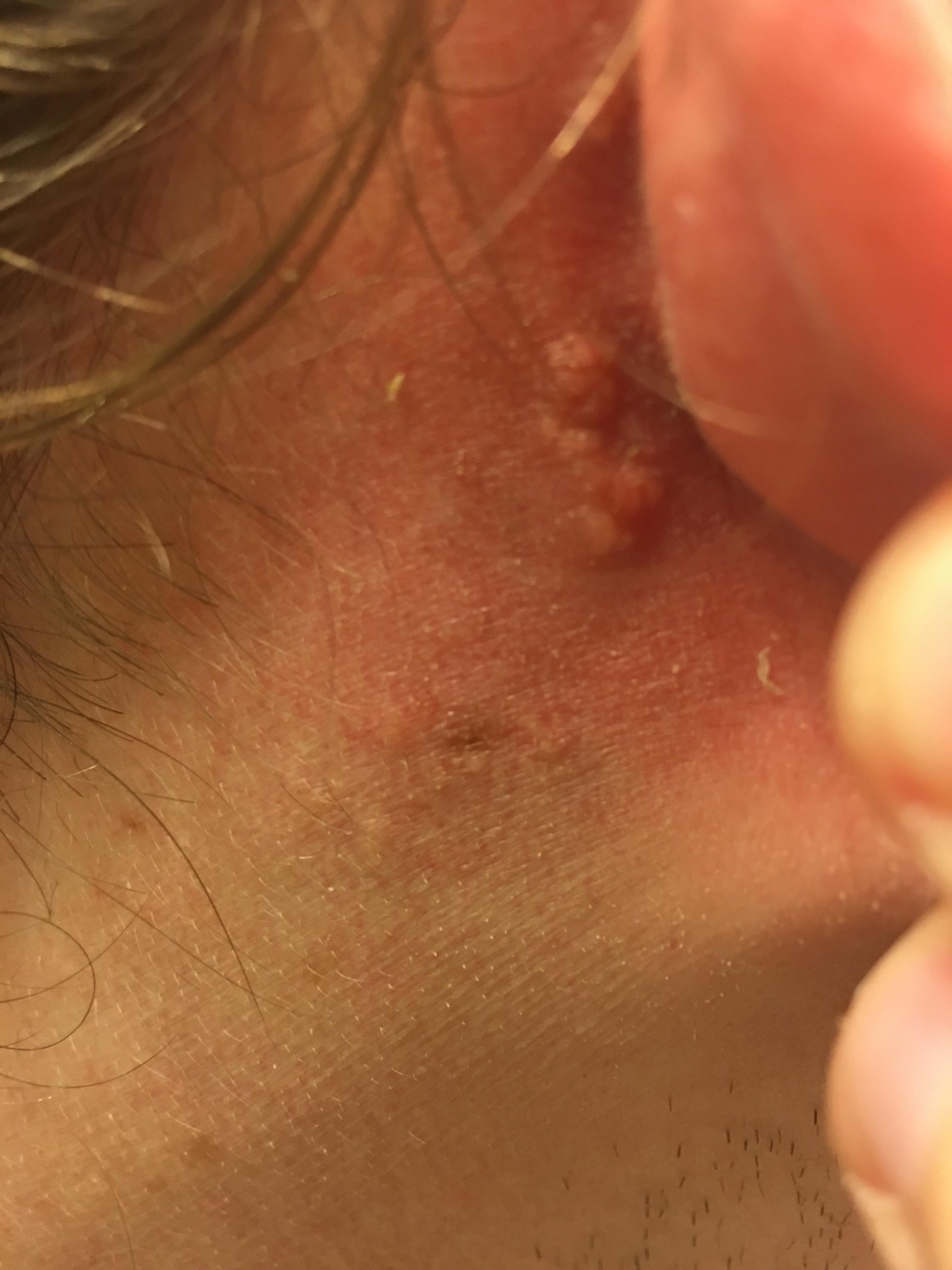 Need help identifying bumps behind ear Dermatology