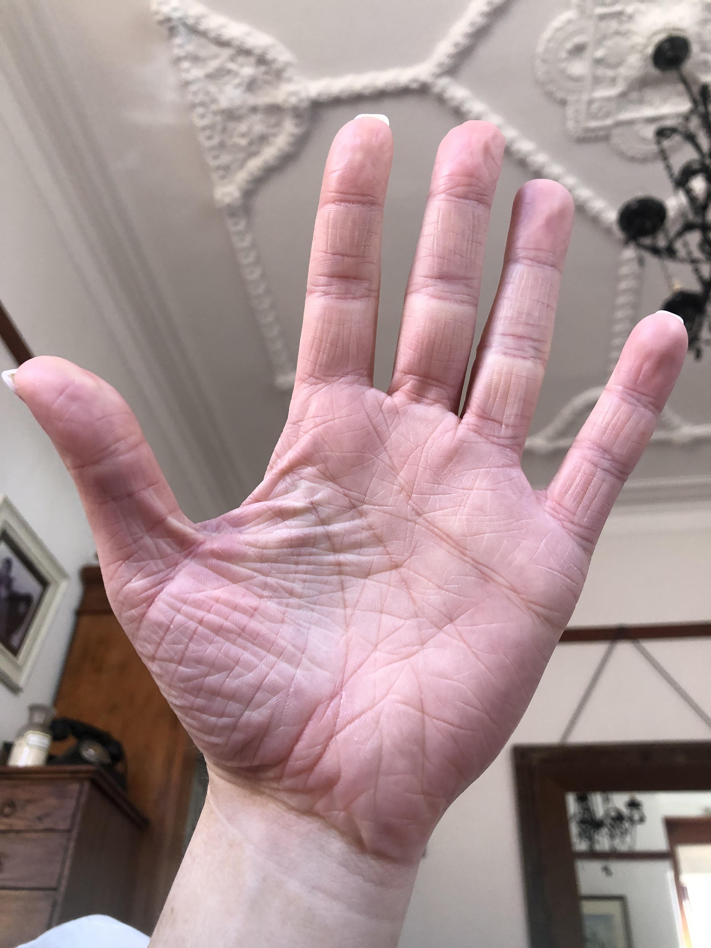 Why are my hands like this? (I’m a 21yr F) r/skin