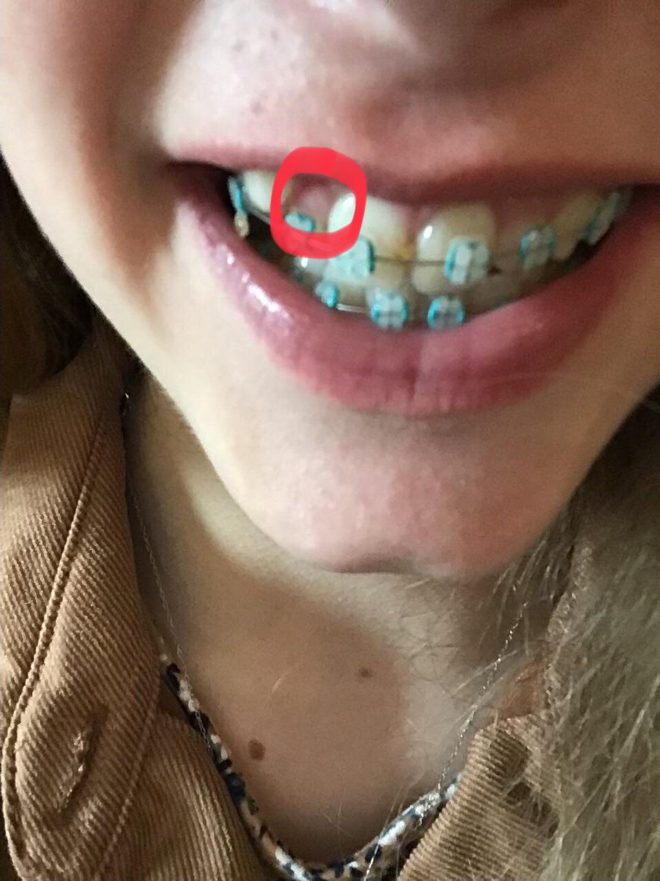 Bump on gums I just noticed this bump on my gums last night when I