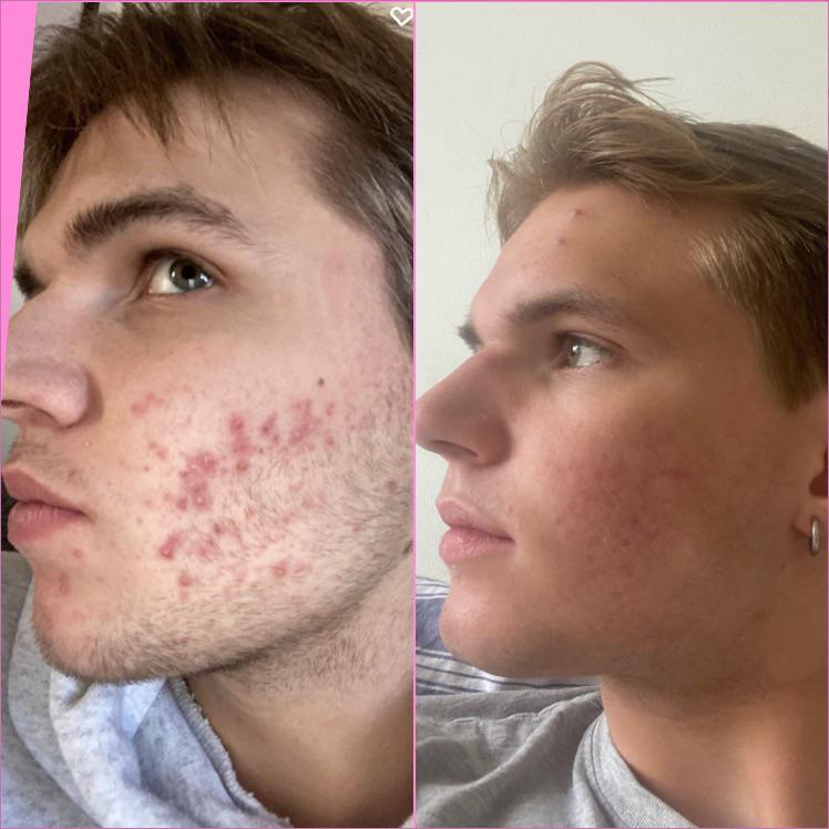 BEFORE after r/Accutane