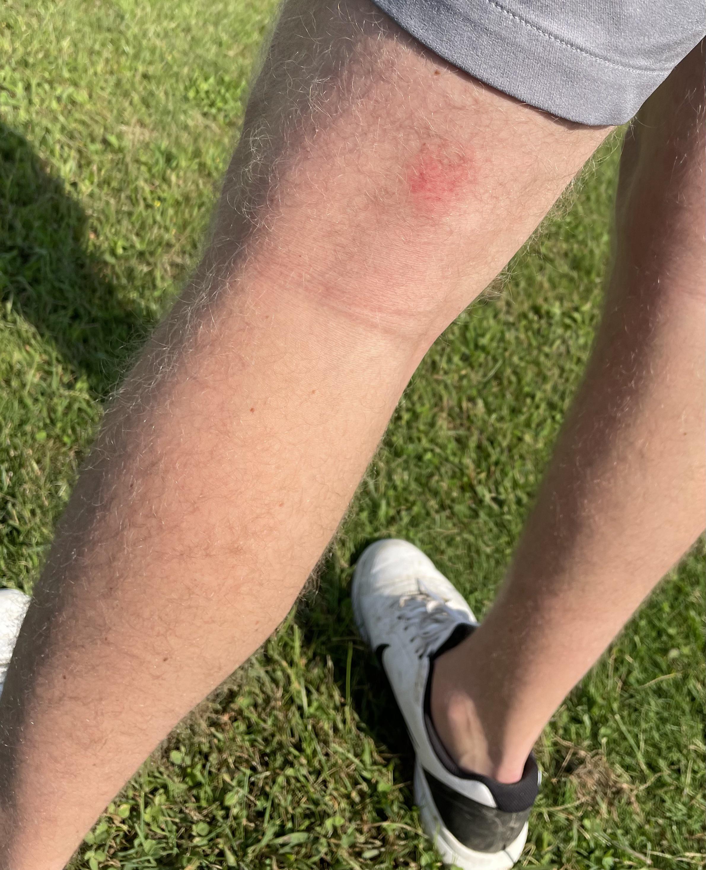 Got hit in the back of leg on the first hole today, guess I shouldn’t