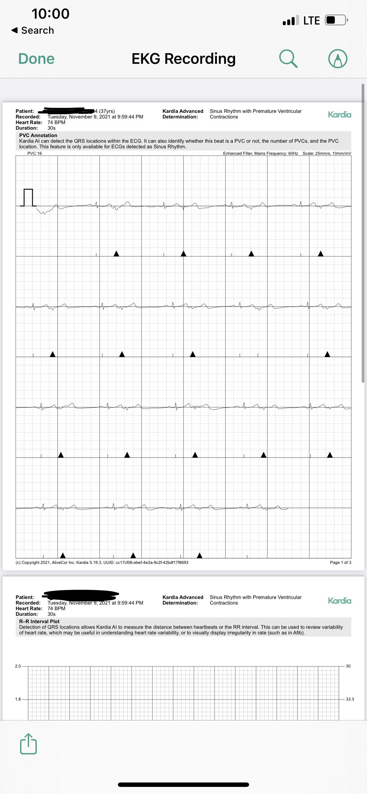 Please help me read this.. does this show every heartbeat is a skipped
