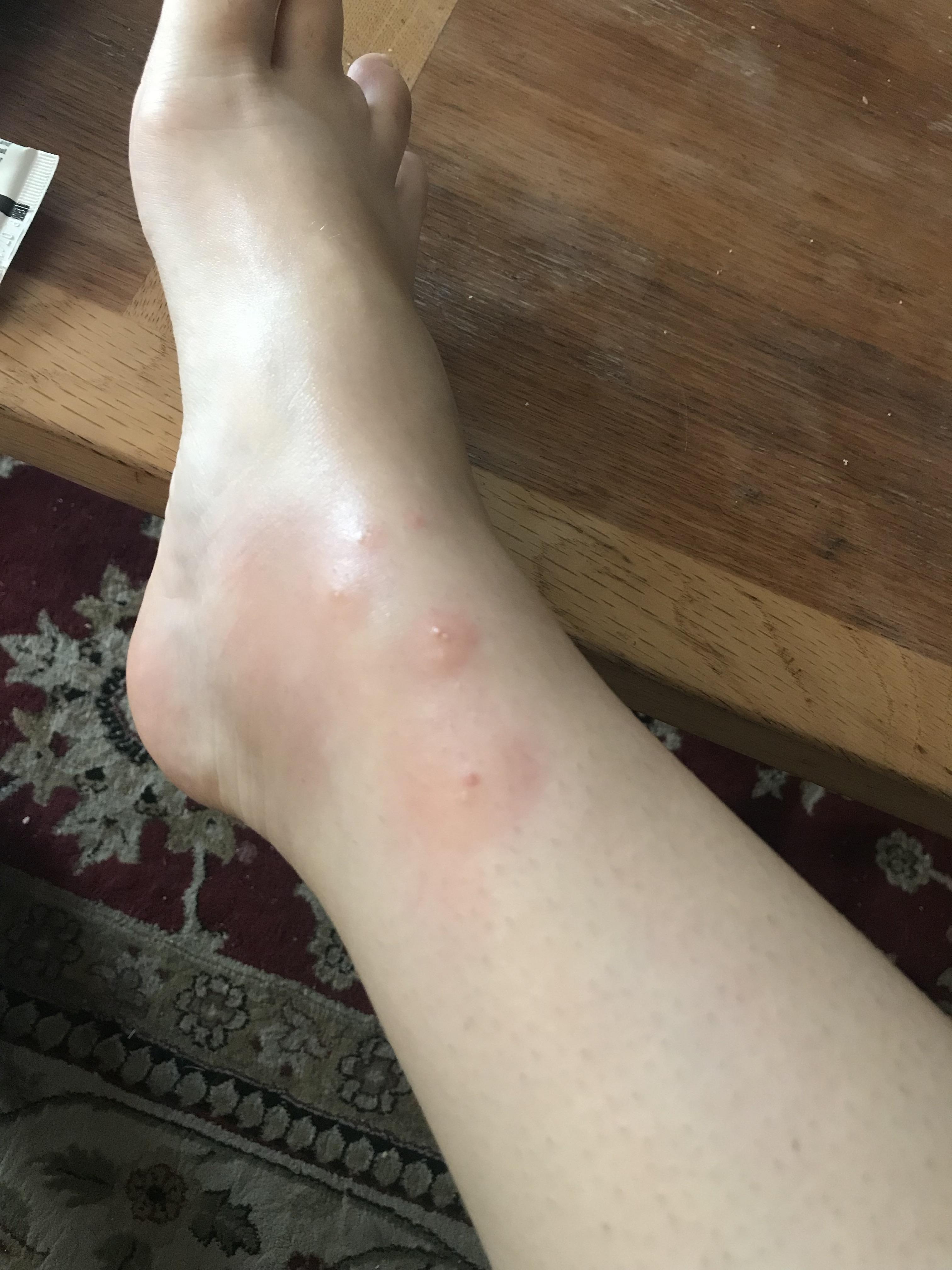 Big Red Ant Bite