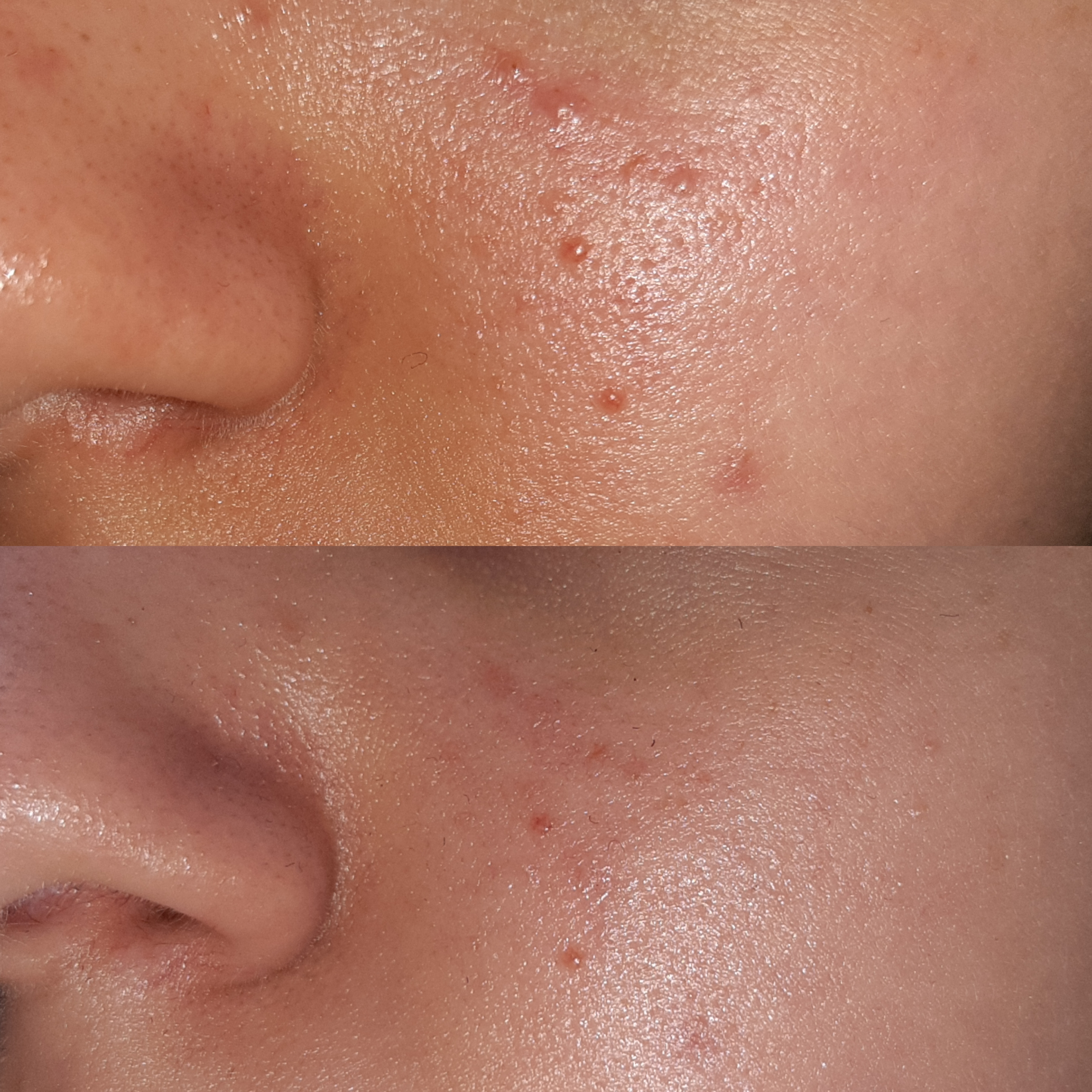 [B&A] Exactly one week of TO's Niacinamide 10 + Zinc 1, seeing