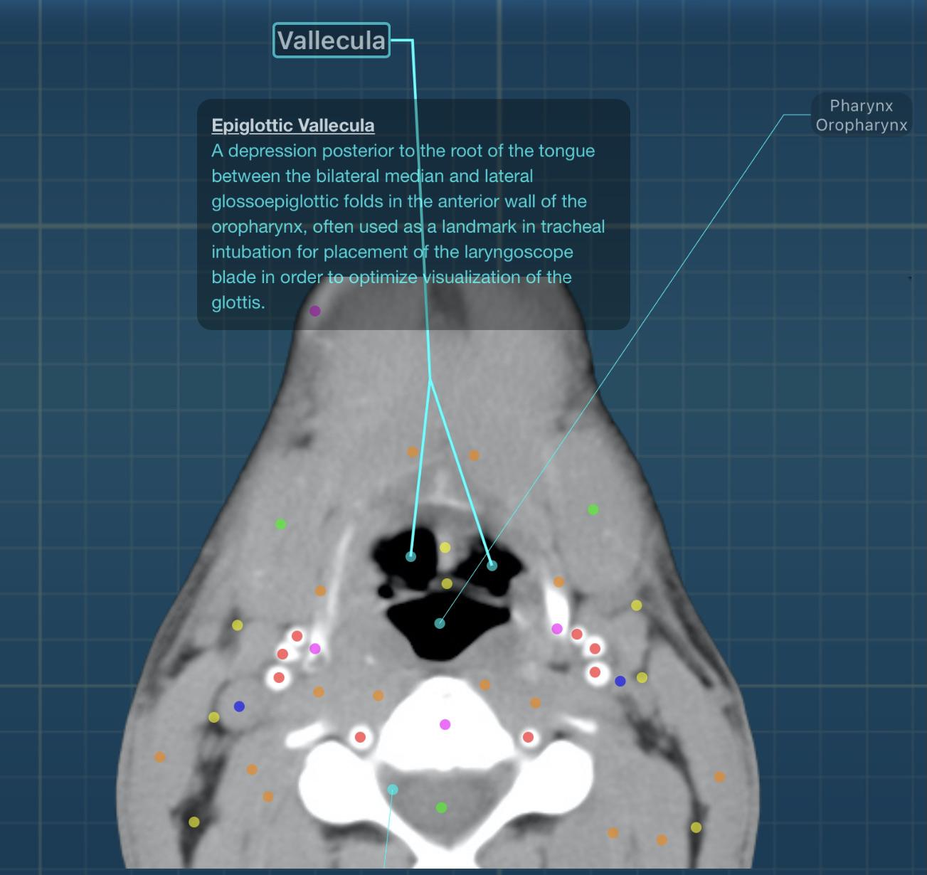 Today's CT anatomy The Epiglottic Vallecula is often used as a
