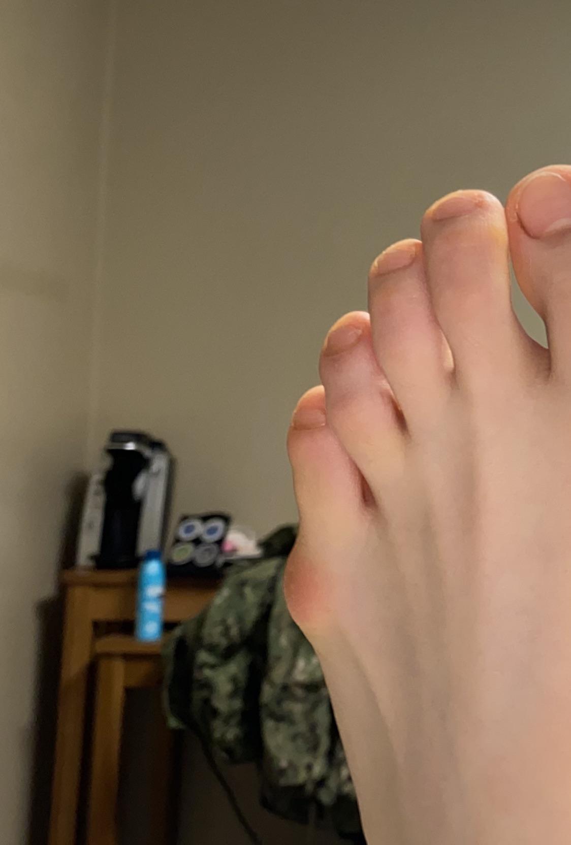 Does this look like a bunion? r/bunions