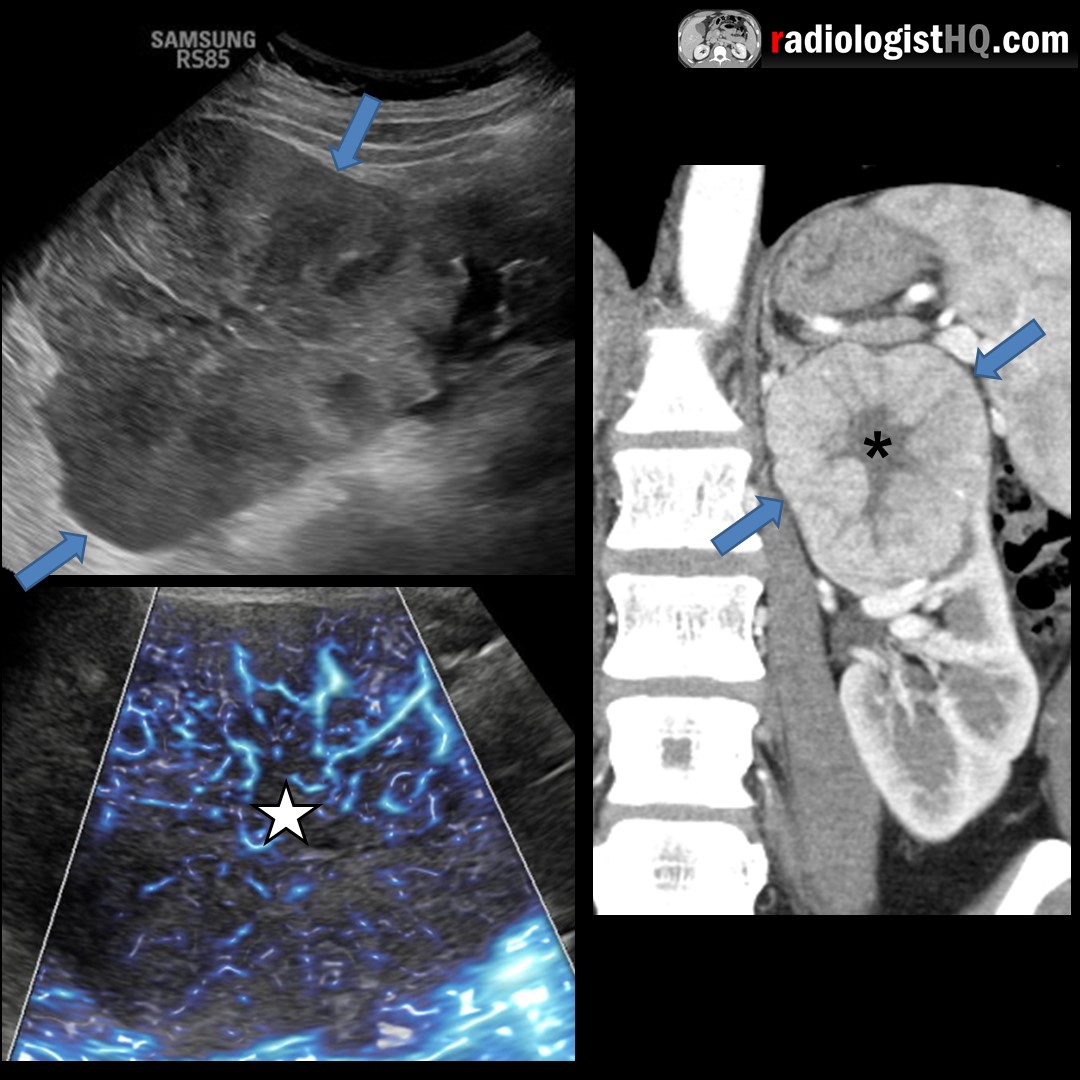 Ultrasound & CT of Renal Oncocytoma r/Radiology