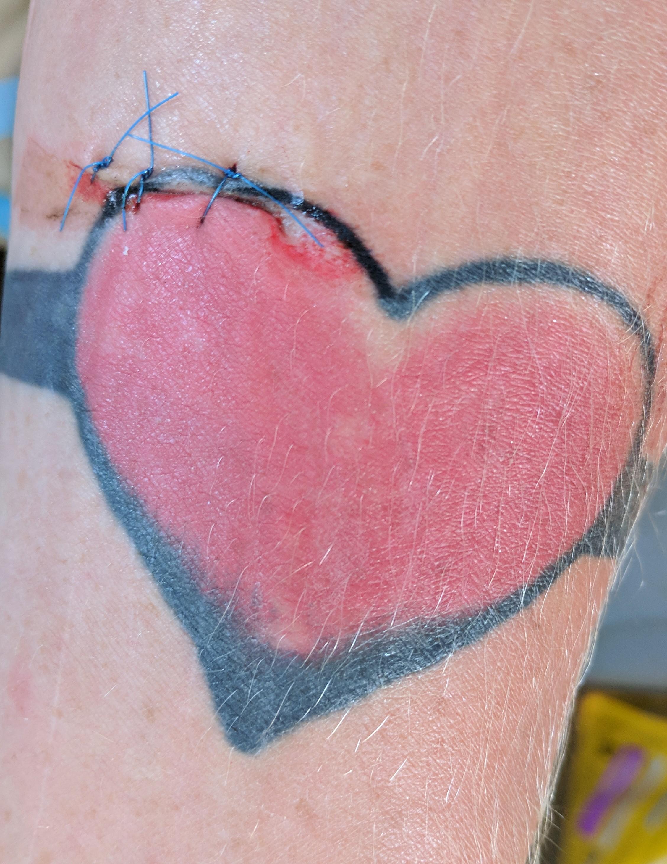 Heart Stitch Pain Intercostal