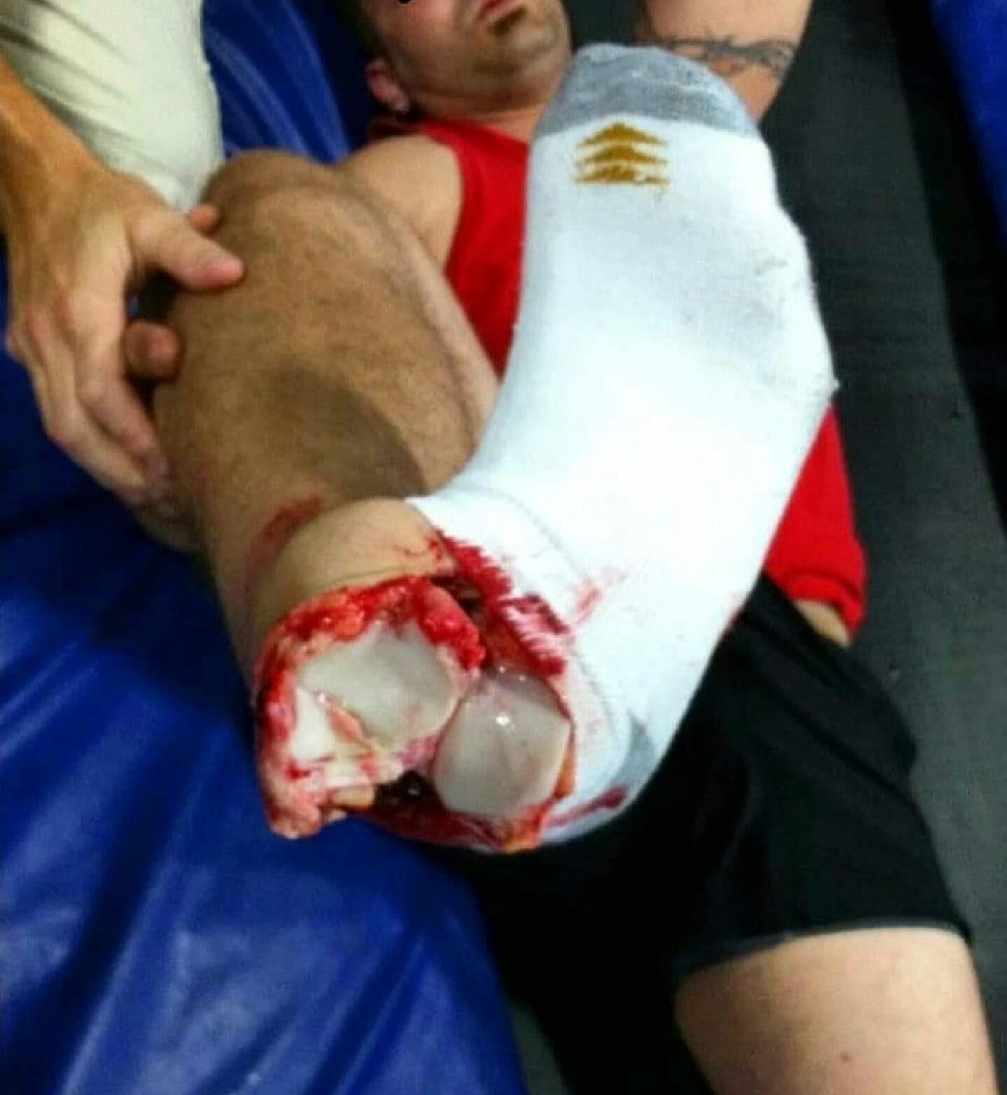 243 best r/nsfl__ images on Pholder Conor Mcgregor broke his Leg