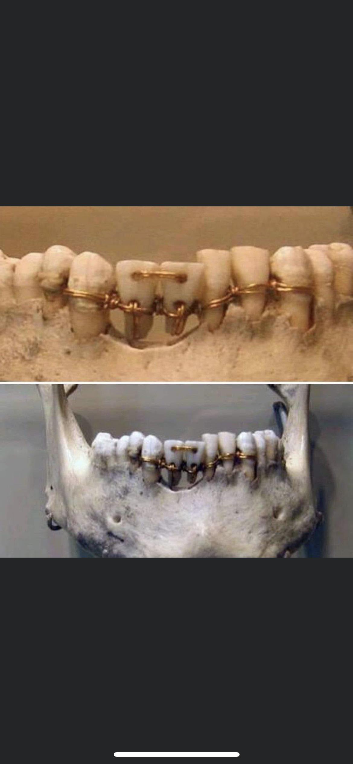 Ancient Egyptian dental work from 2000 BC r/Damnthatsinteresting